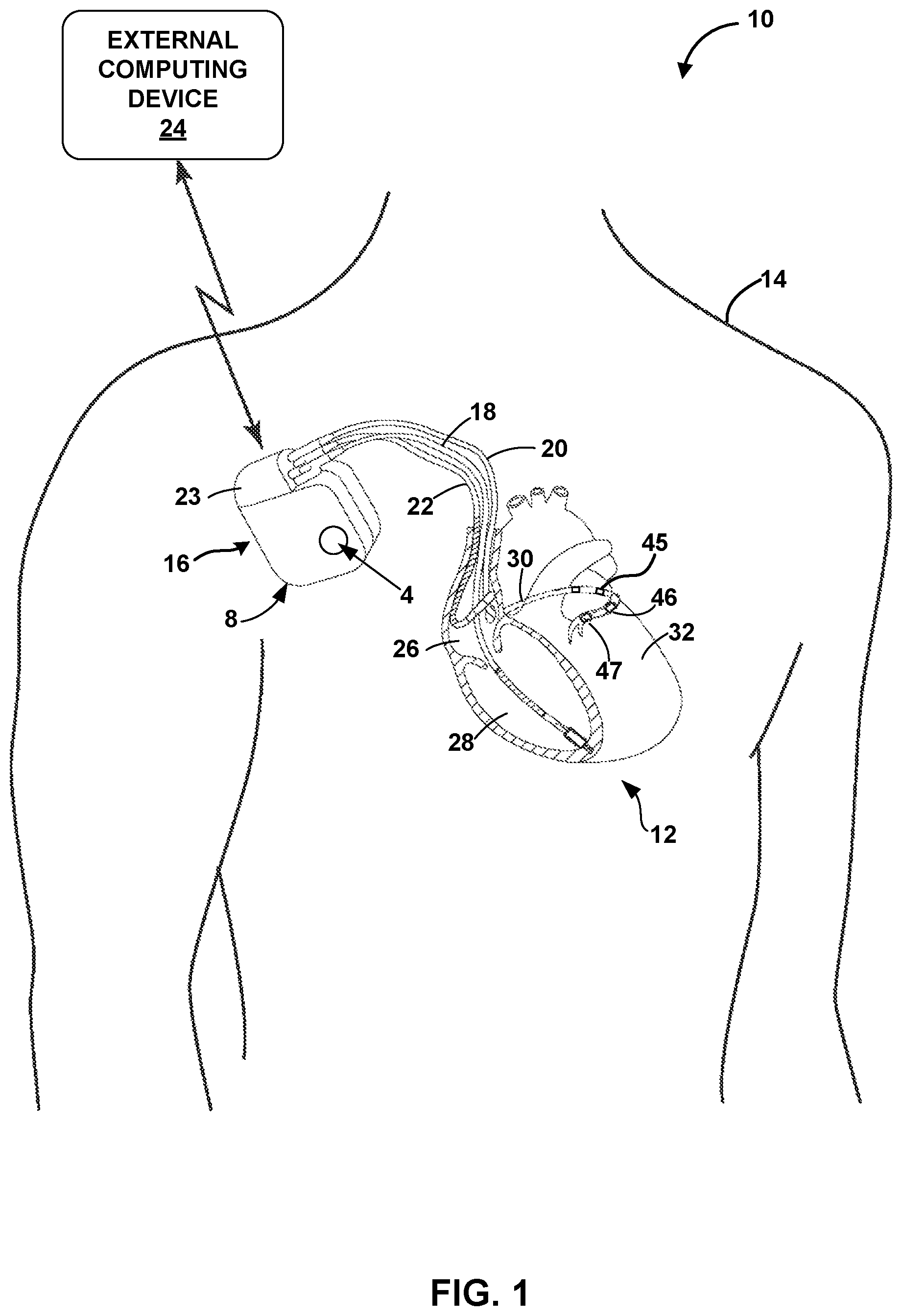 Patent US12311183 — Current steering for cardiac pacing — Figure 1