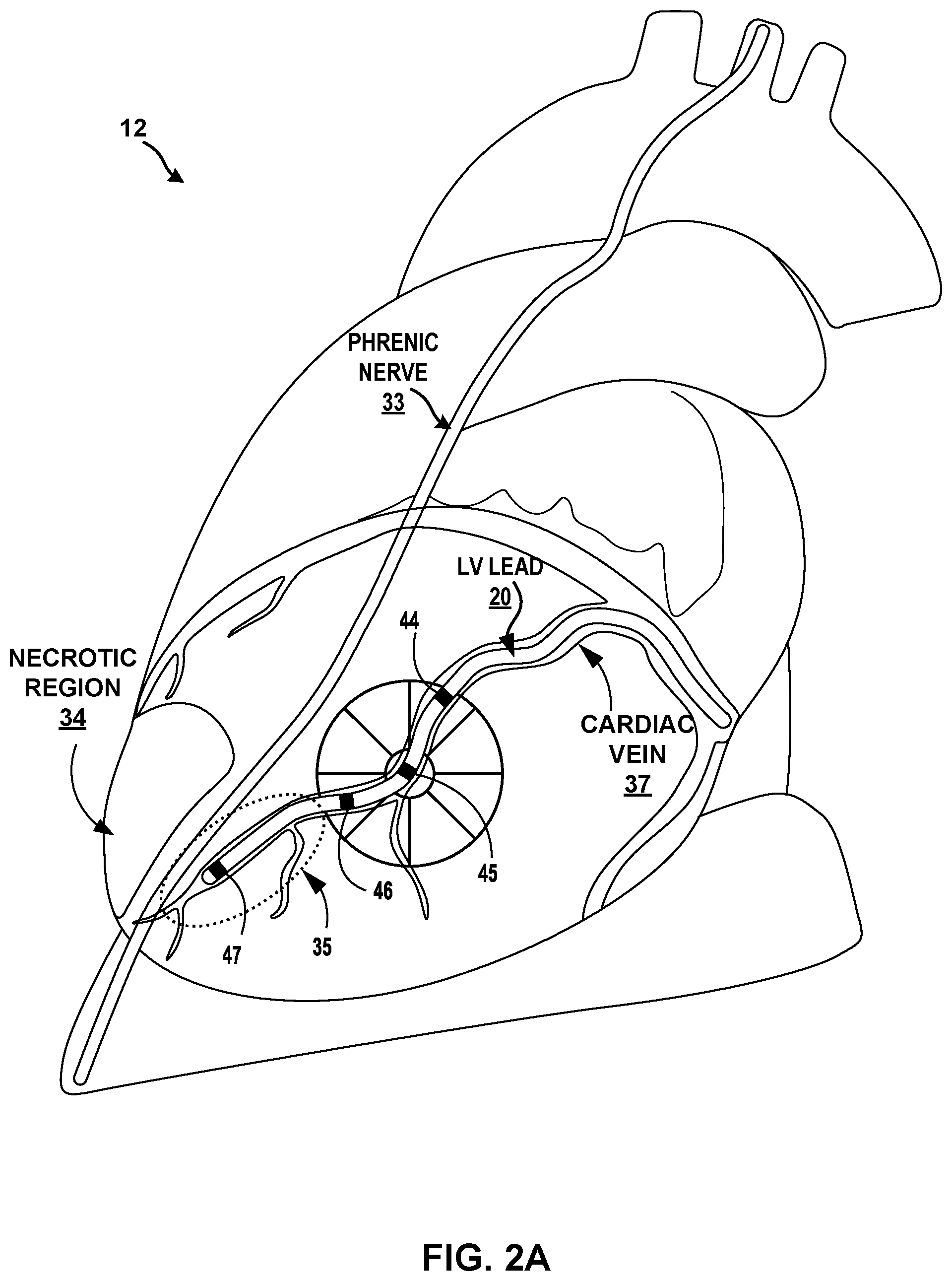 Patent US12311183 Figure 2 – Current steering for cardiac pacing