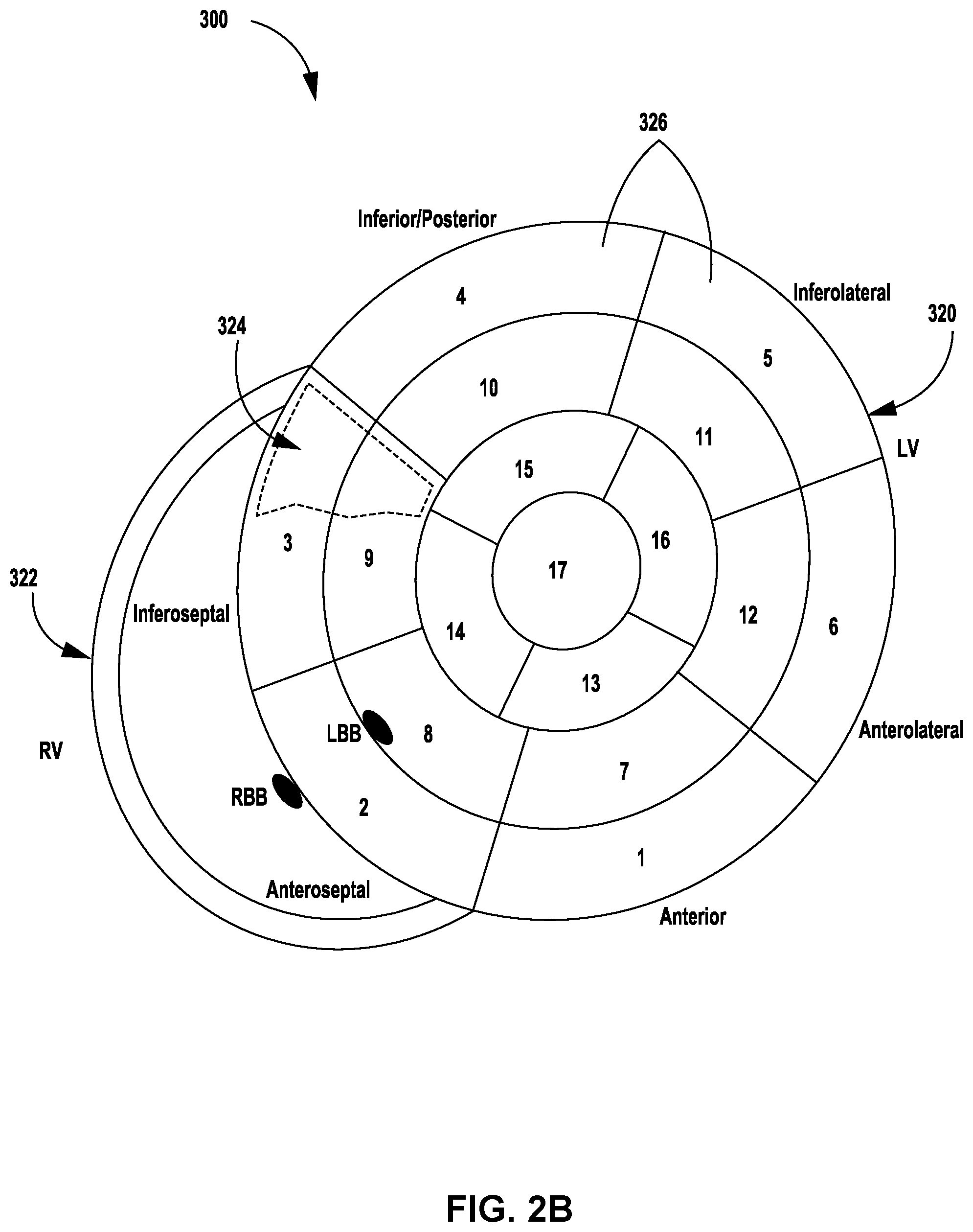 Patent US12311183 Figure 3 – Current steering for cardiac pacing