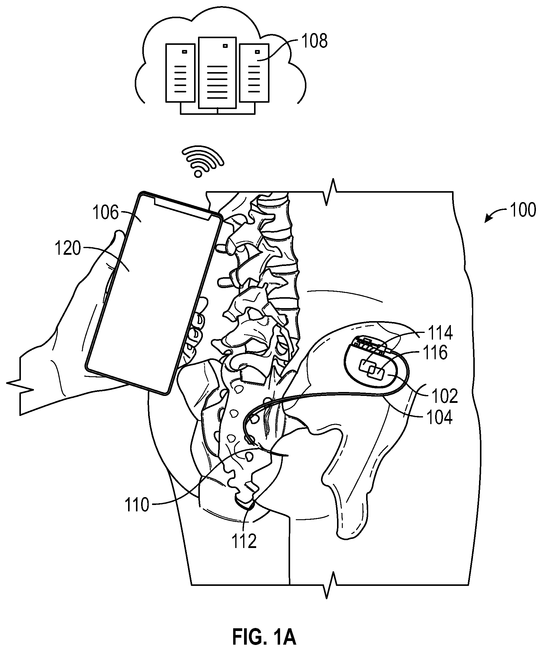 Patent US12311184 Figure 1 – Method and user interface for managing duty-cycled electrical nerve stimulation