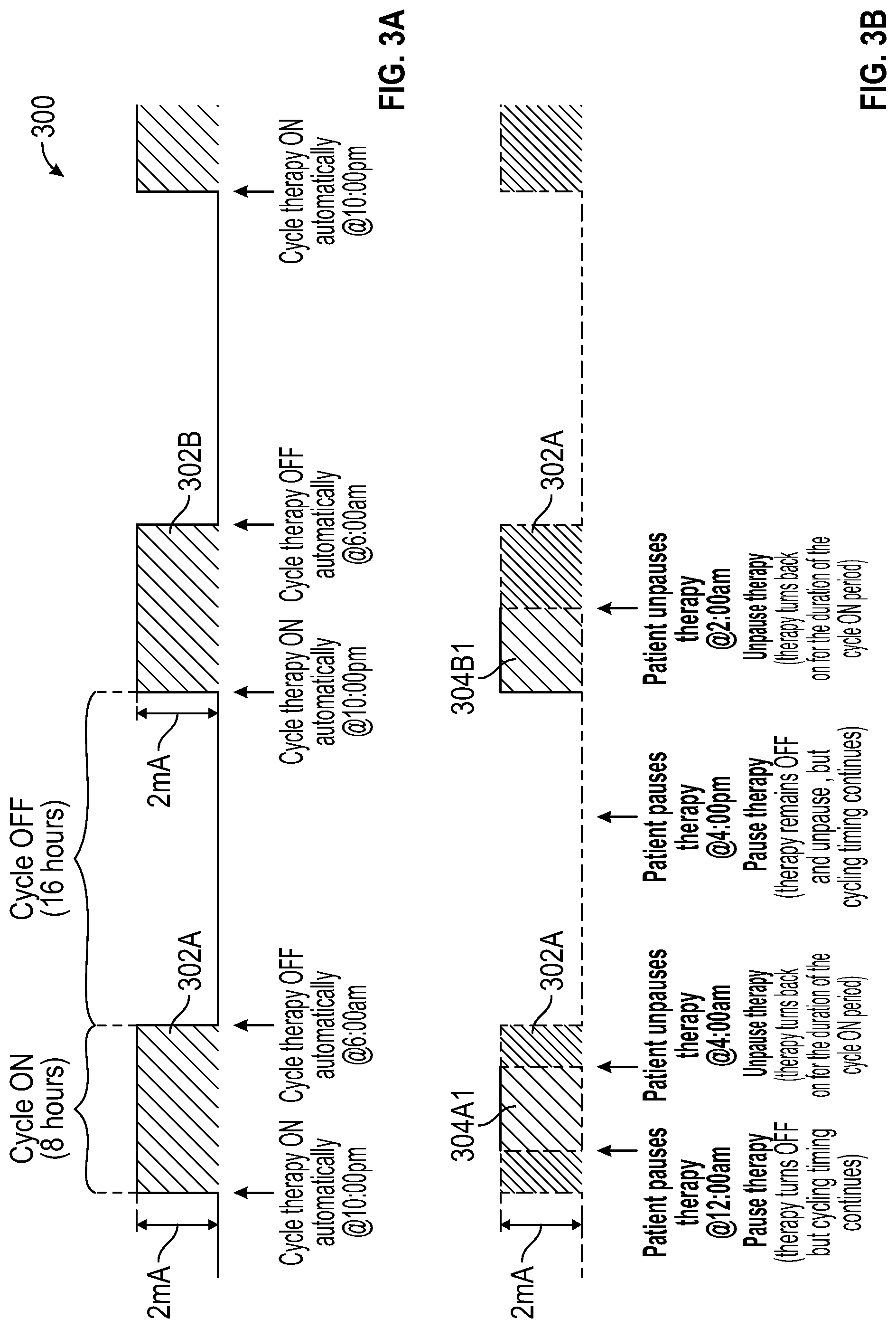 Patent US12311184 Figure 4 – Method and user interface for managing duty-cycled electrical nerve stimulation