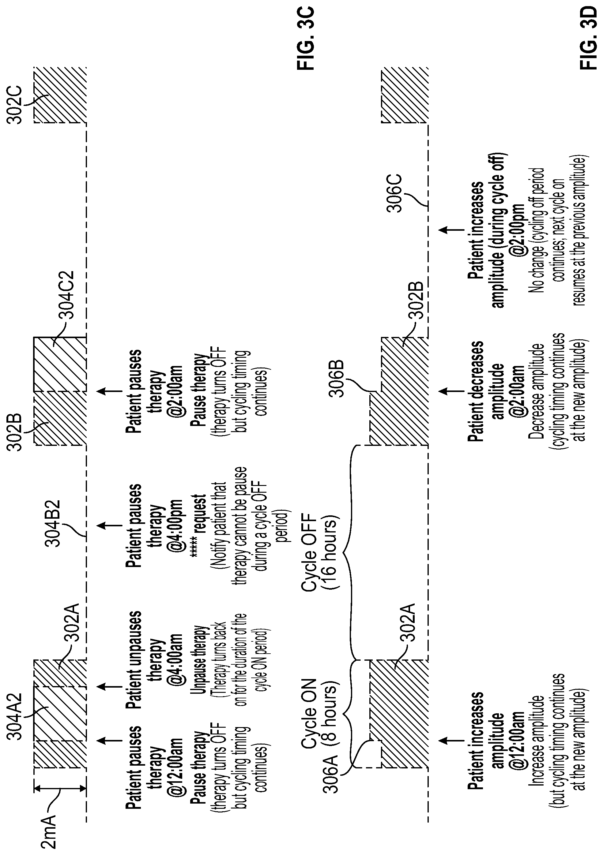 Patent US12311184 Figure 5 – Method and user interface for managing duty-cycled electrical nerve stimulation