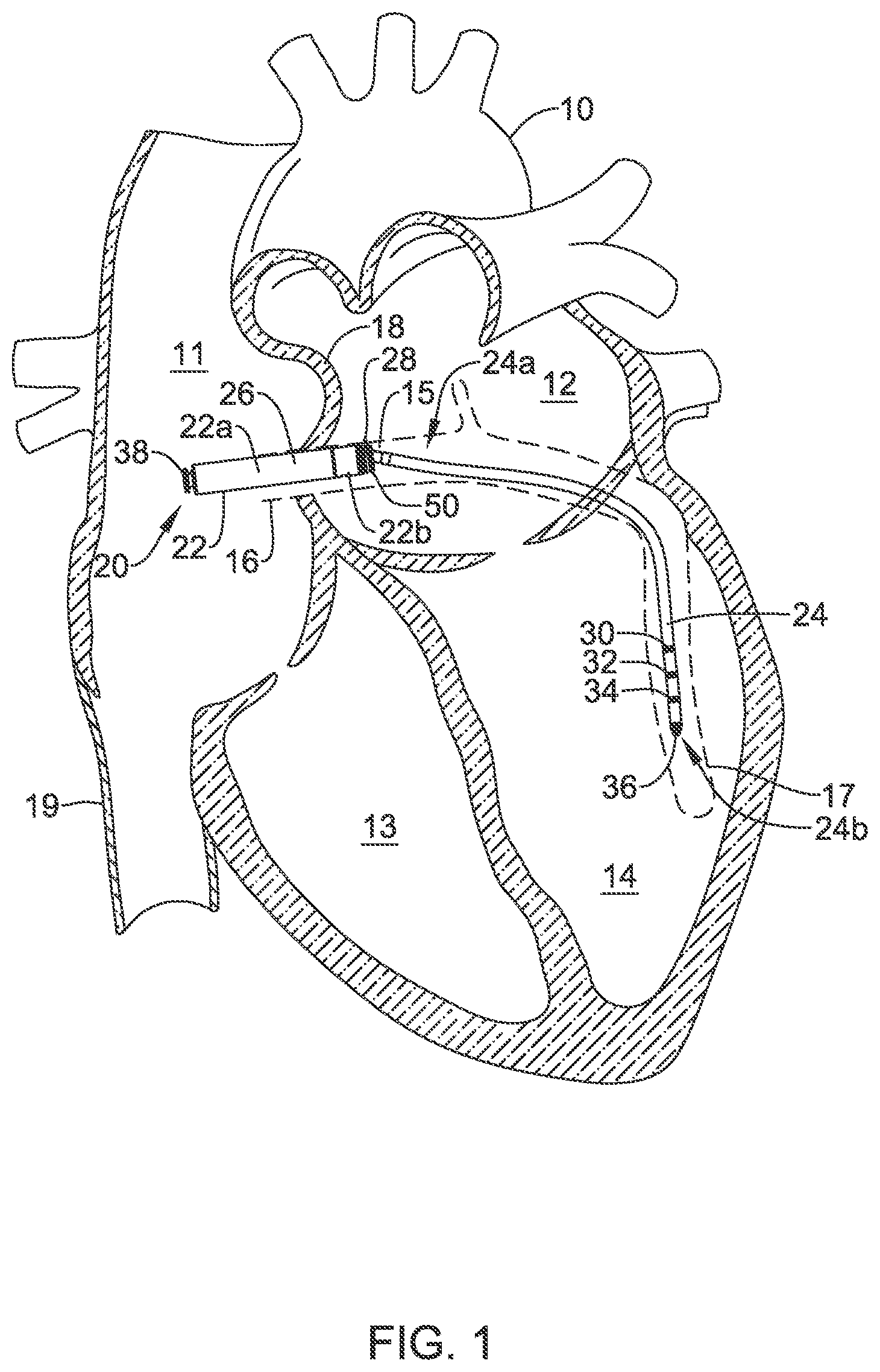 Patent US12311186 Figure 1 – Systems and methods for treating cardiac arrhythmias