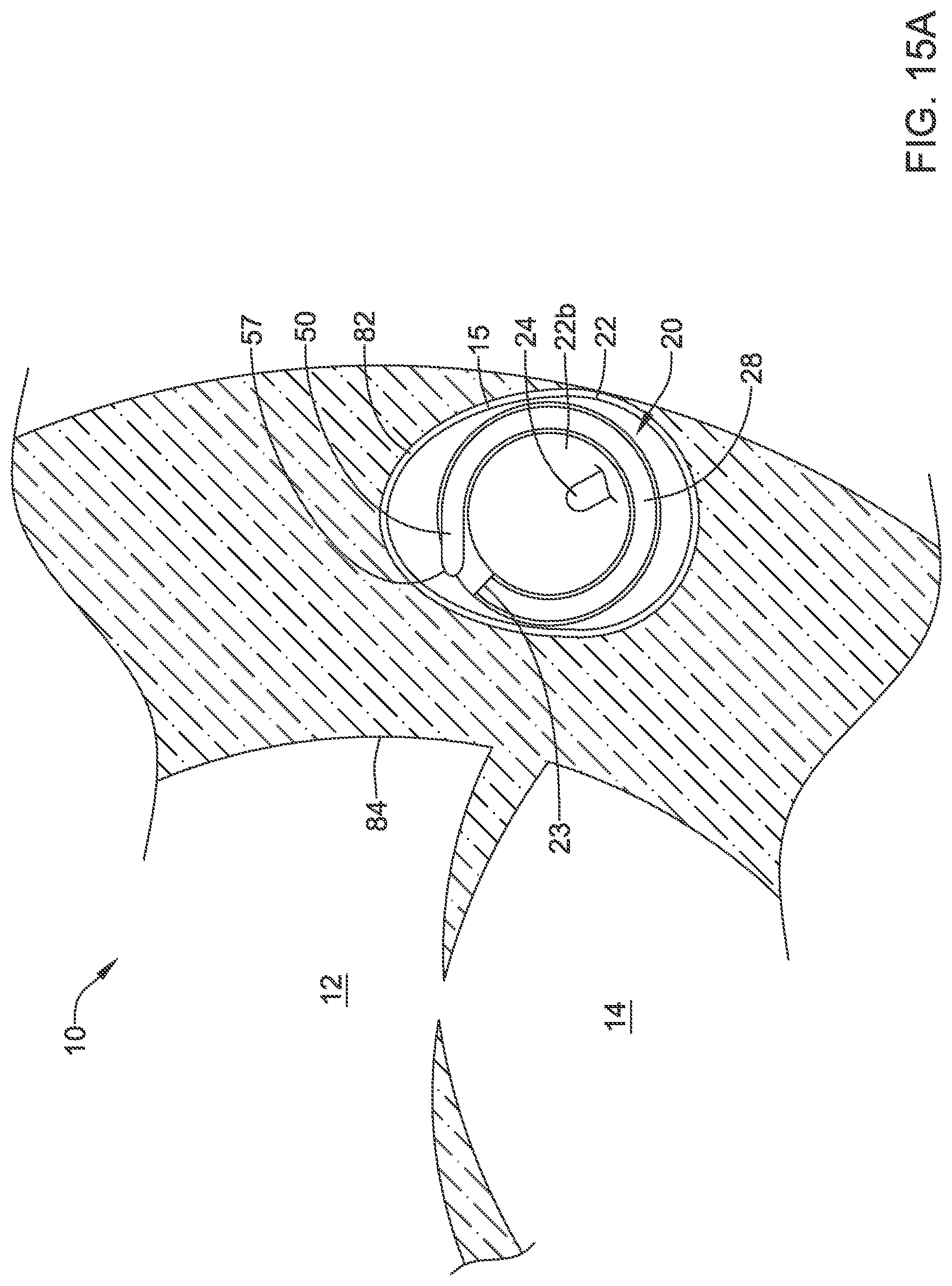 Patent US12311186 Figure 15 – Systems and methods for treating cardiac arrhythmias