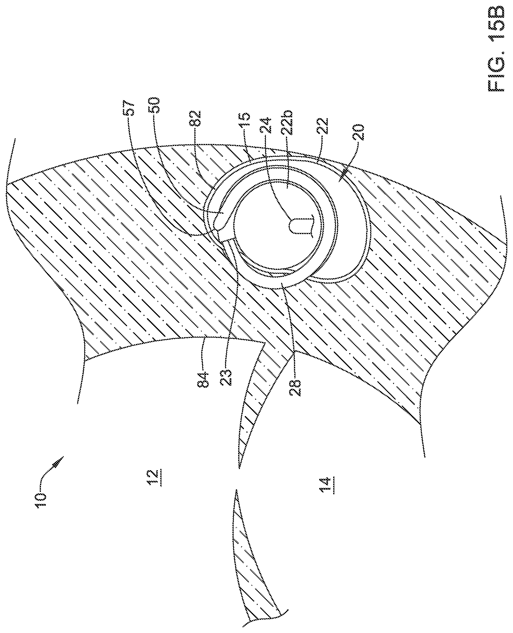 Patent US12311186 Figure 16 – Systems and methods for treating cardiac arrhythmias