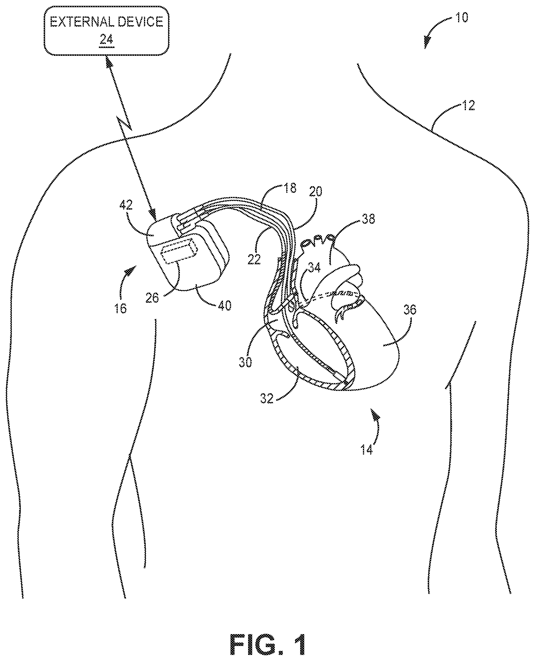 Patent US12311187 Figure 1 – Battery assembly for medical device