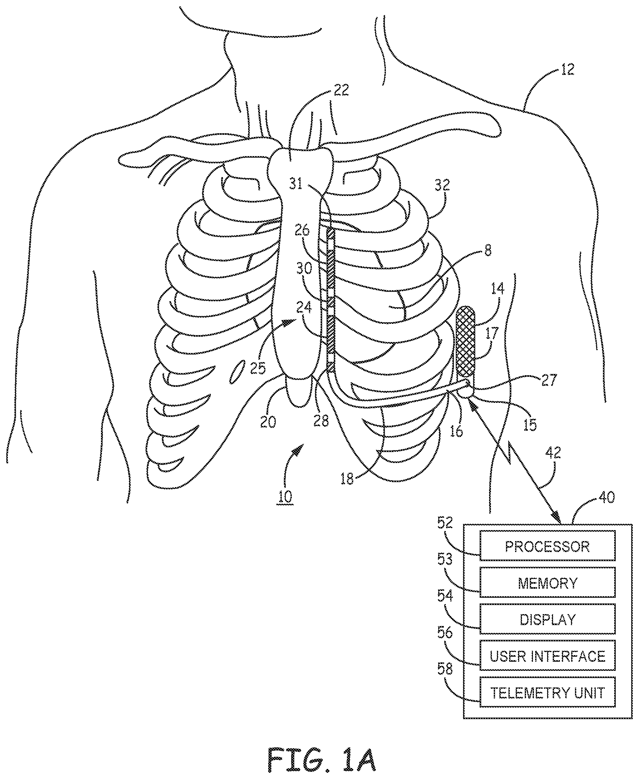 Patent US12311189 Figure 1 – Multi-threshold sensing of cardiac electrical signals in an extracardiovascular implantable cardioverter defibrillator