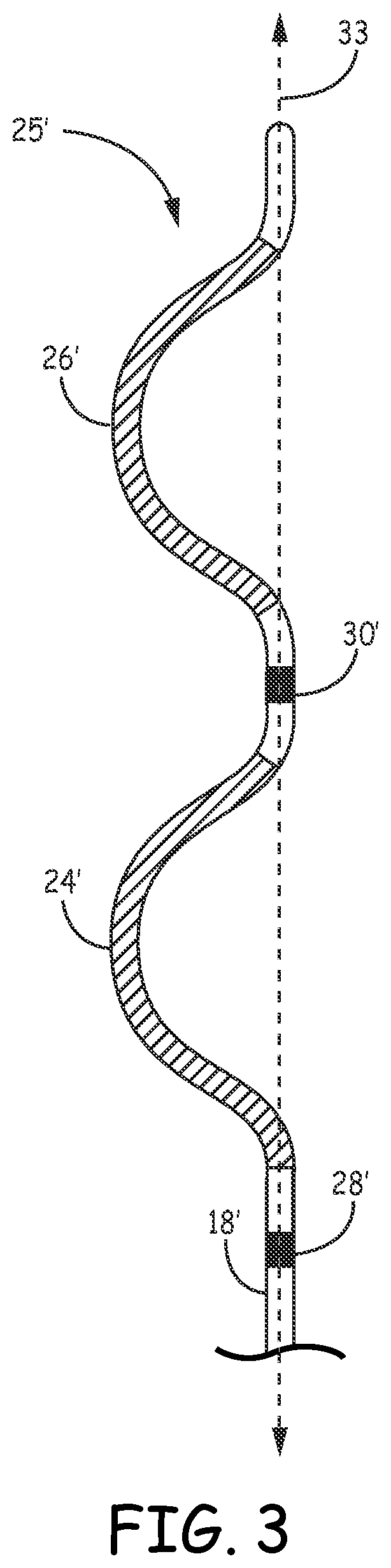 Patent US12311189 Figure 6 – Multi-threshold sensing of cardiac electrical signals in an extracardiovascular implantable cardioverter defibrillator