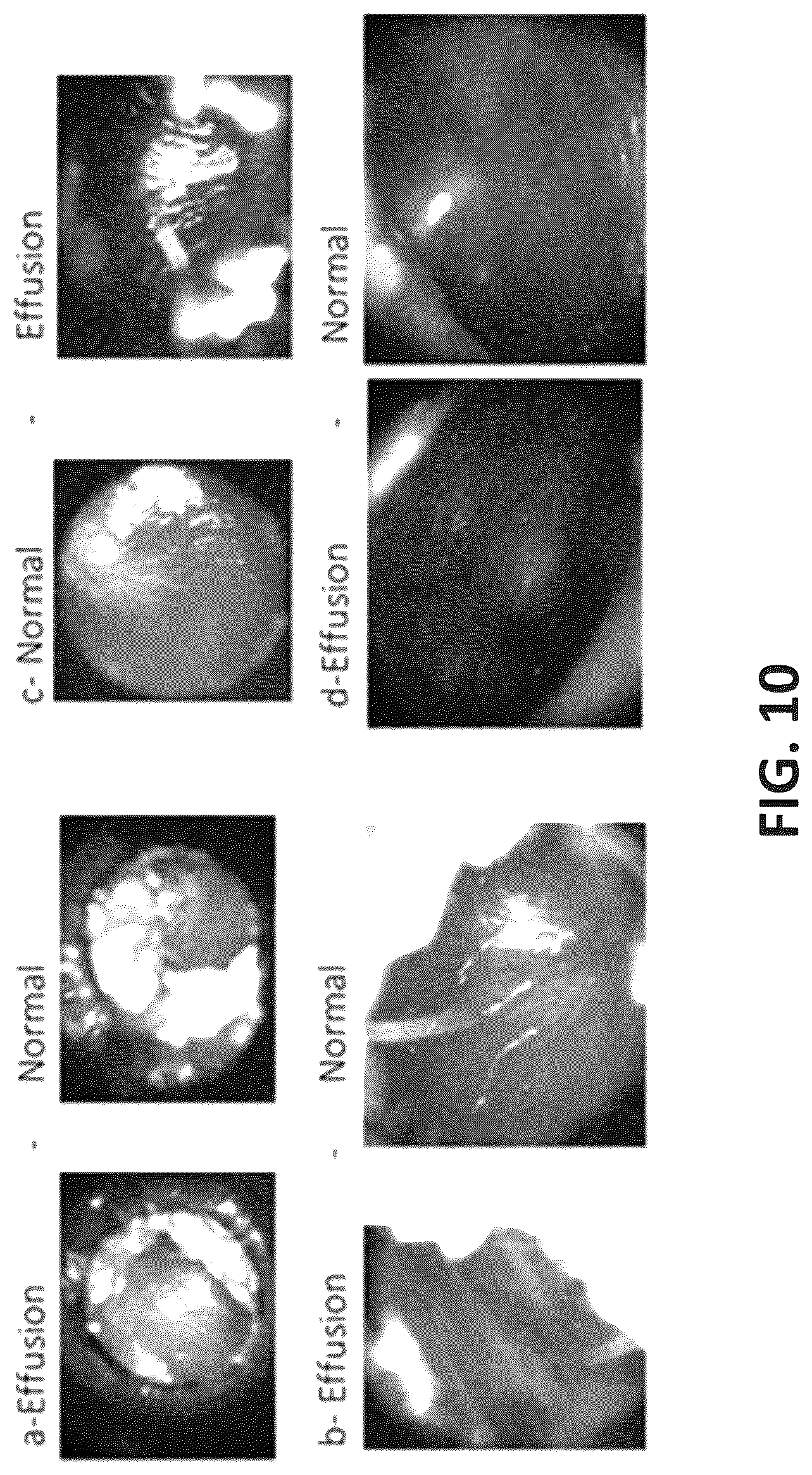 Patent US12315143 Figure 11 – System and method of using right and left eardrum otoscopy images for automated otoscopy image analysis to diagnose ear pathology
