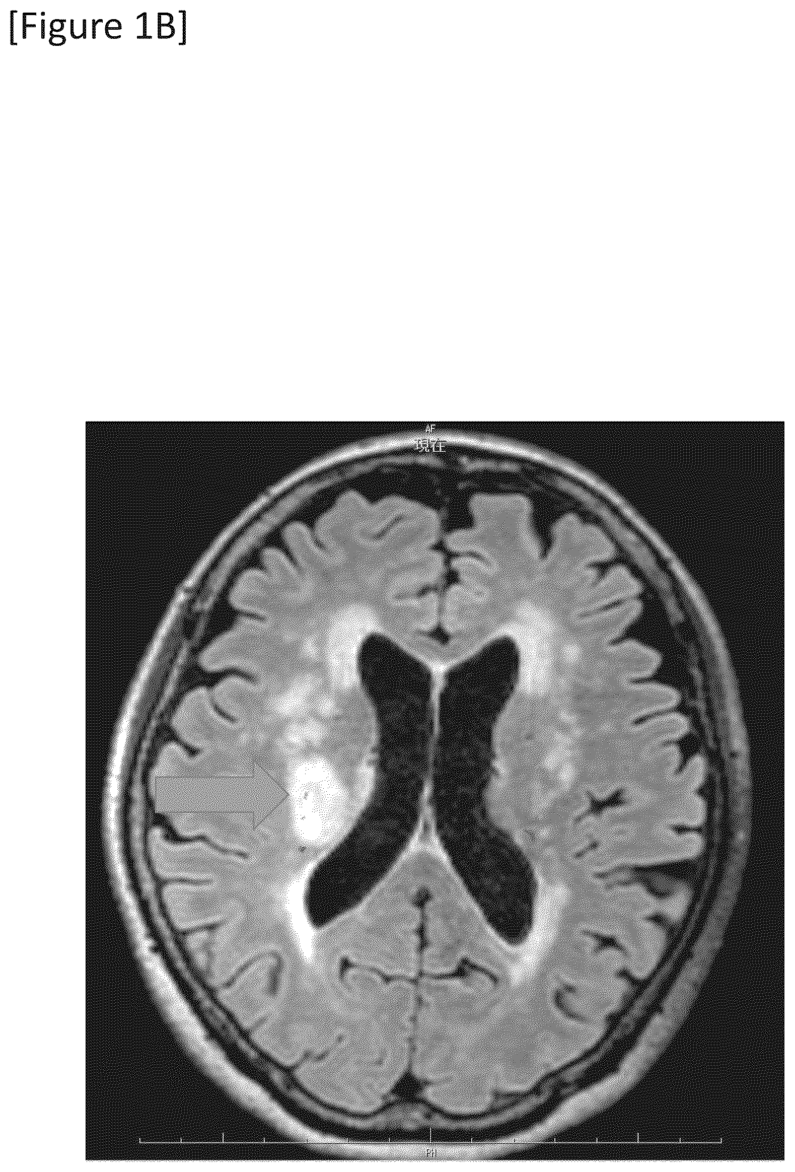 Patent US12315148 Figure 2 – Integrated system for safe intracranial administration of cells