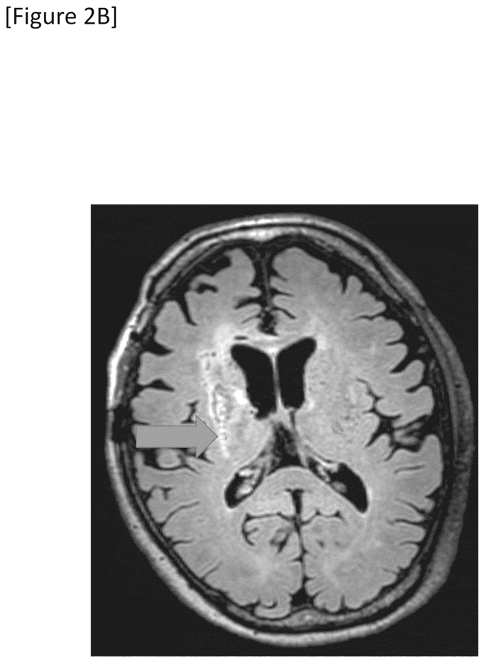 Patent US12315148 Figure 5 – Integrated system for safe intracranial administration of cells