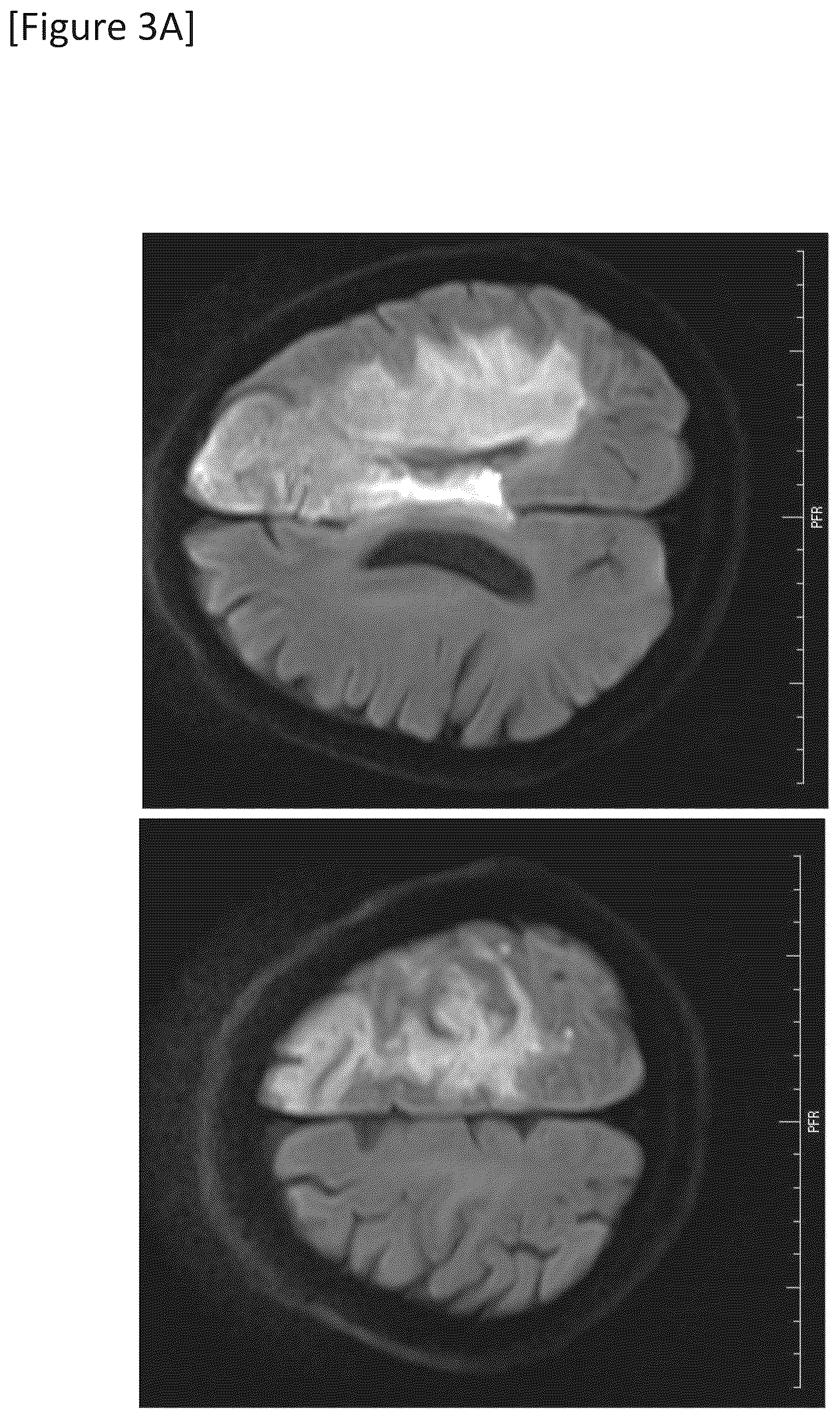 Patent US12315148 Figure 7 – Integrated system for safe intracranial administration of cells