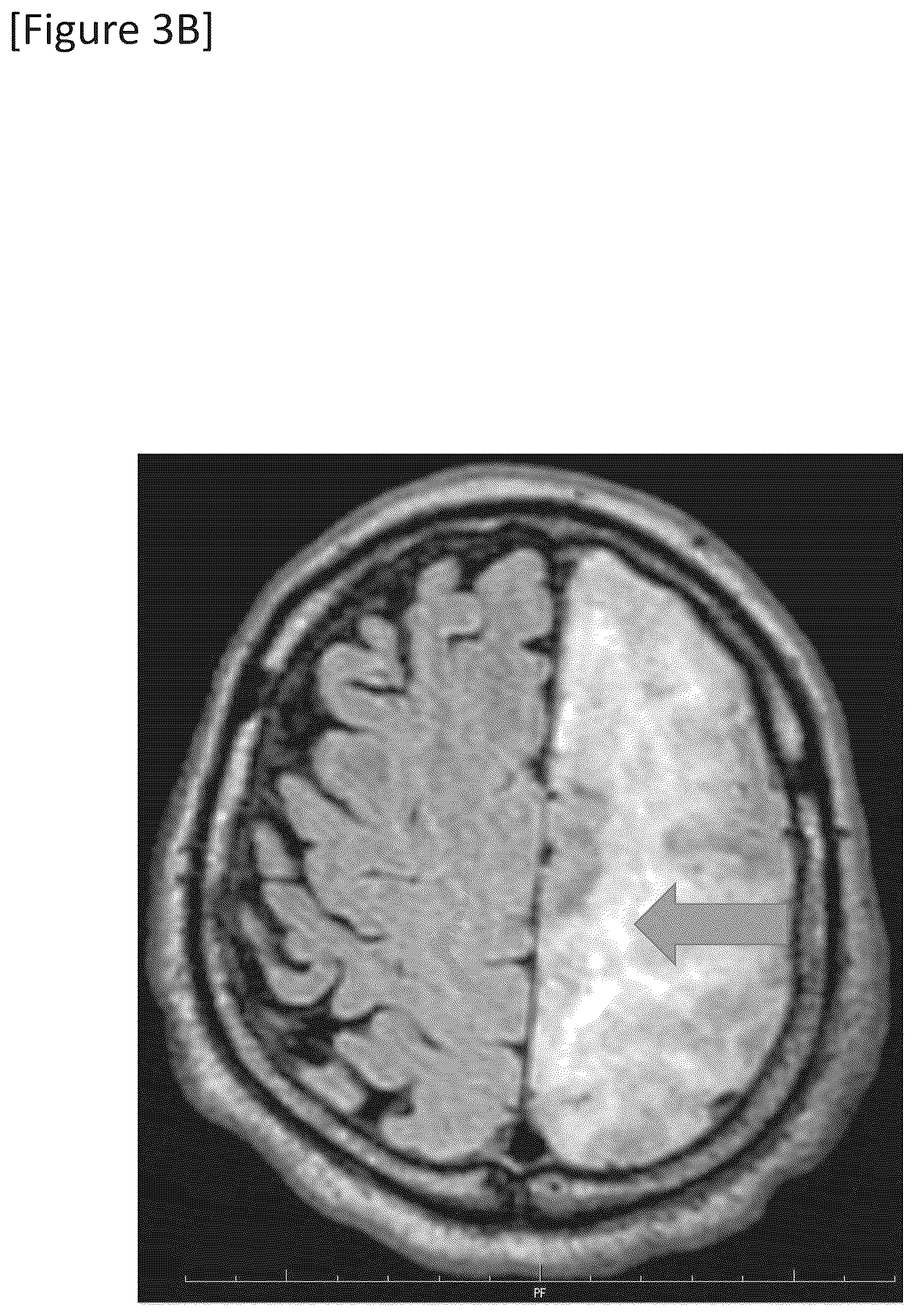 Patent US12315148 Figure 8 – Integrated system for safe intracranial administration of cells