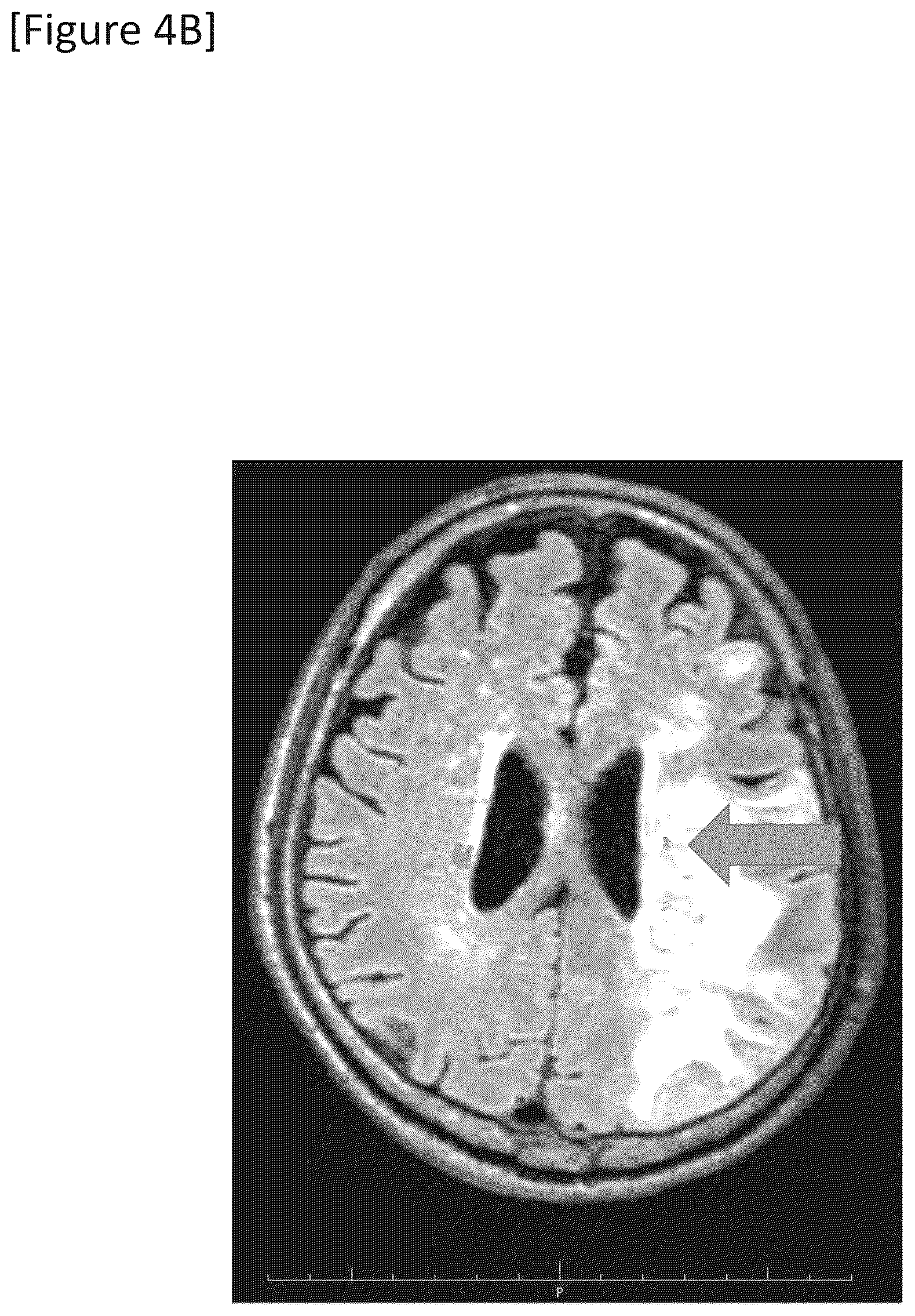Patent US12315148 Figure 11 – Integrated system for safe intracranial administration of cells