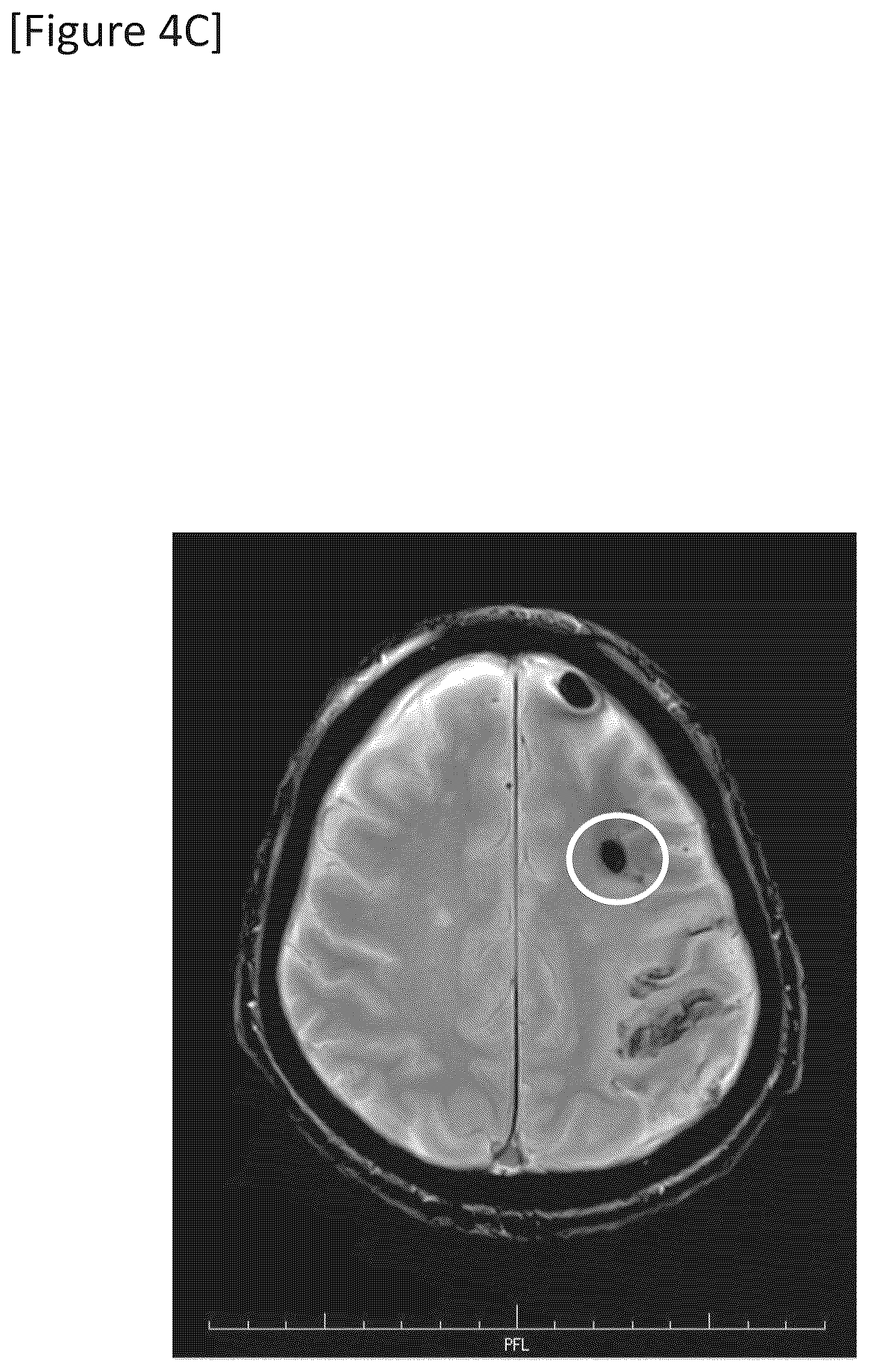 Patent US12315148 Figure 12 – Integrated system for safe intracranial administration of cells