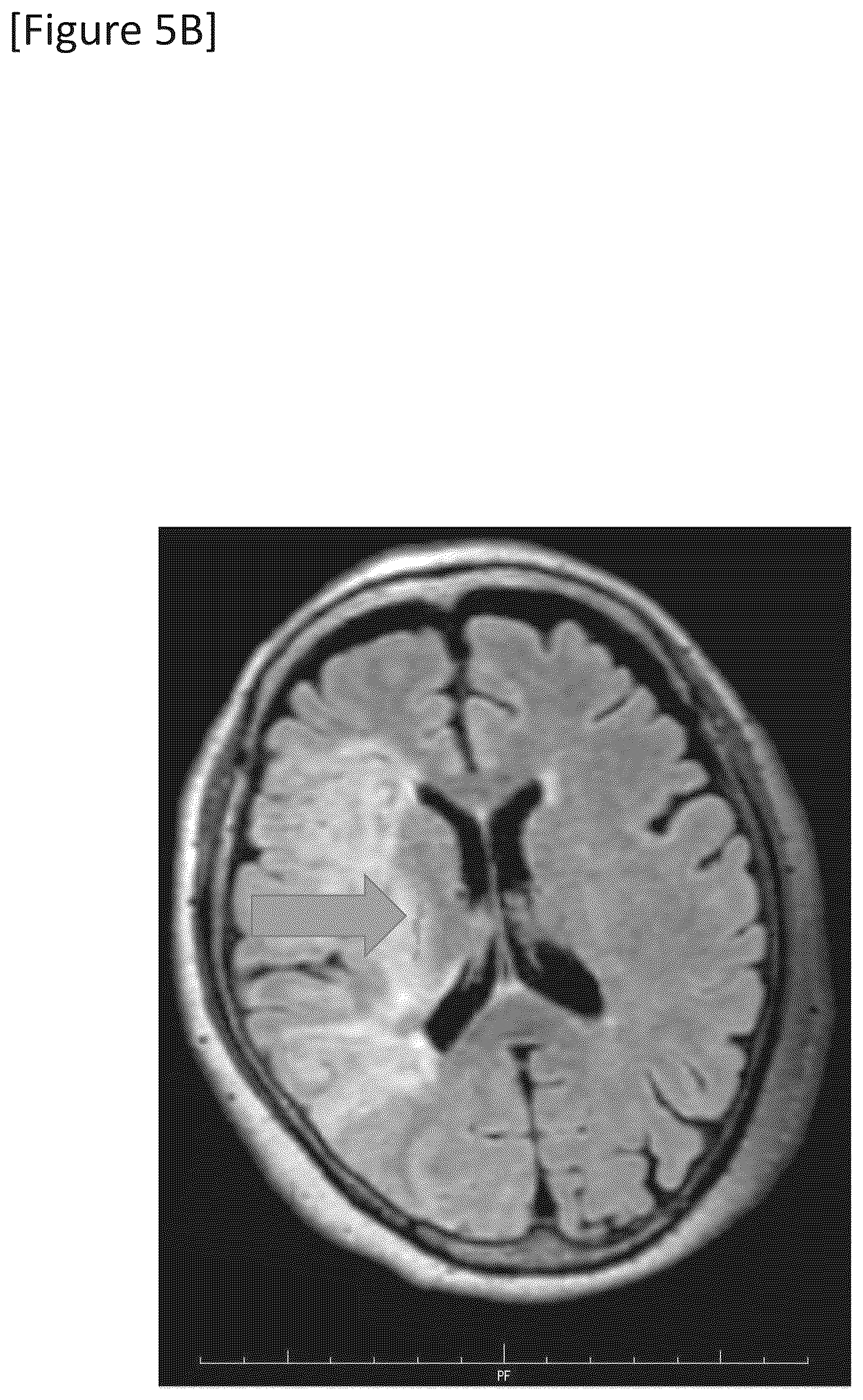 Patent US12315148 Figure 14 – Integrated system for safe intracranial administration of cells