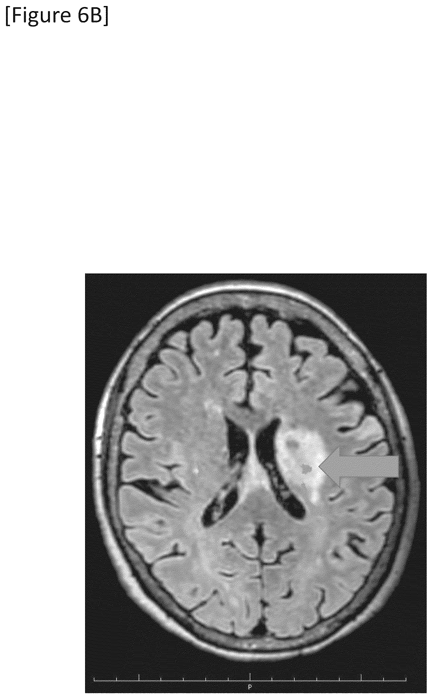 Patent US12315148 Figure 17 – Integrated system for safe intracranial administration of cells