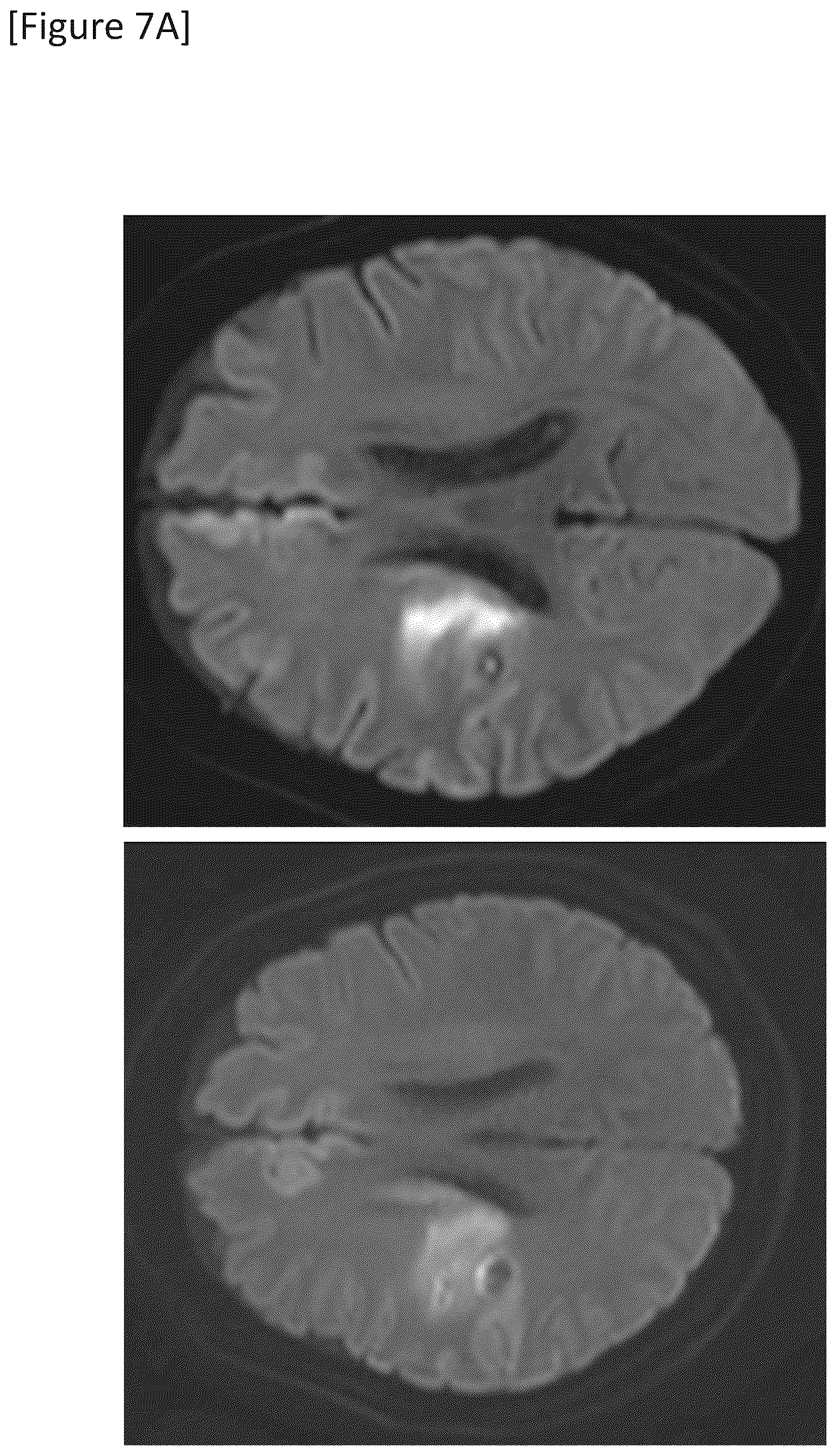 Patent US12315148 Figure 19 – Integrated system for safe intracranial administration of cells