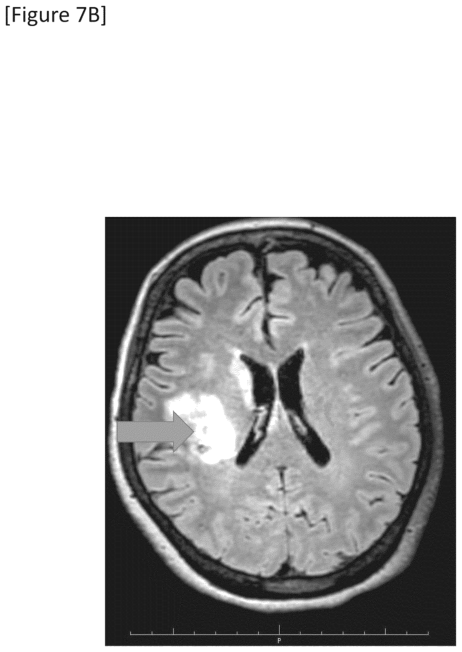 Patent US12315148 Figure 20 – Integrated system for safe intracranial administration of cells