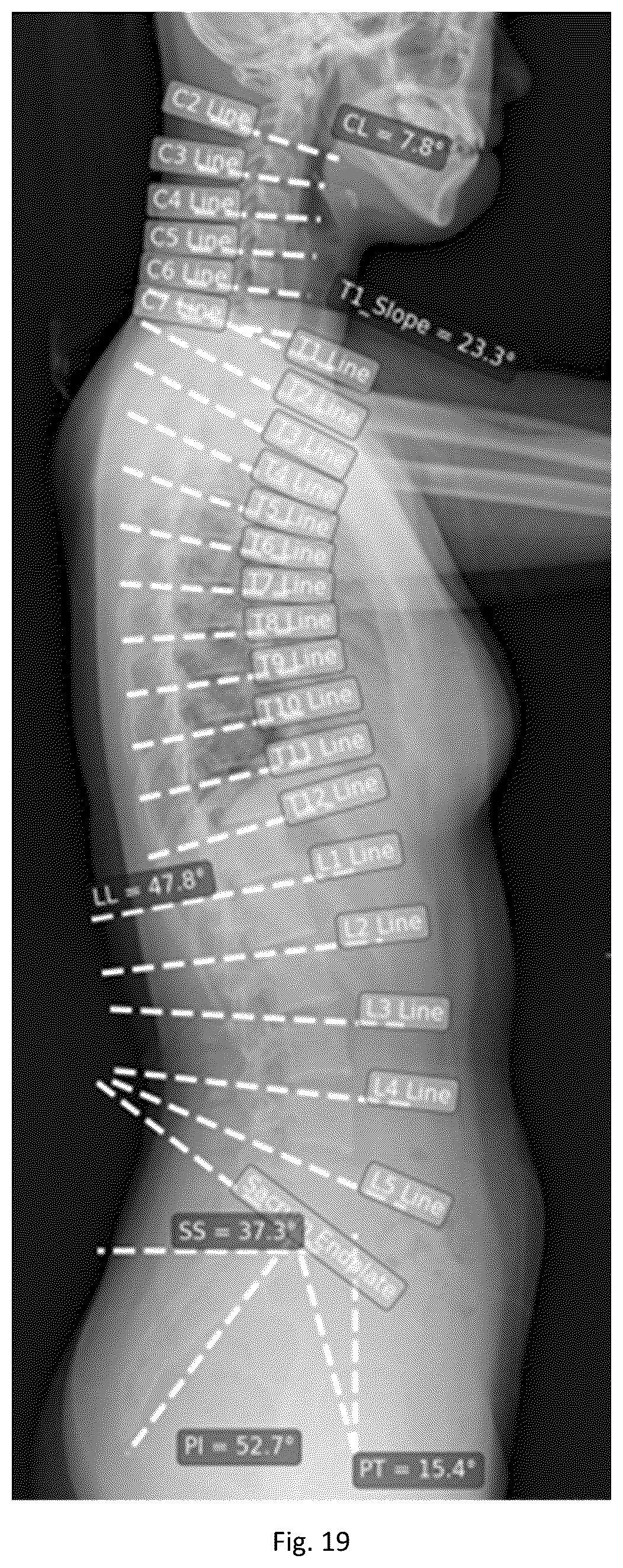 Patent US12315157 Figure 19 – System and method for patient-specific anatomical analyses