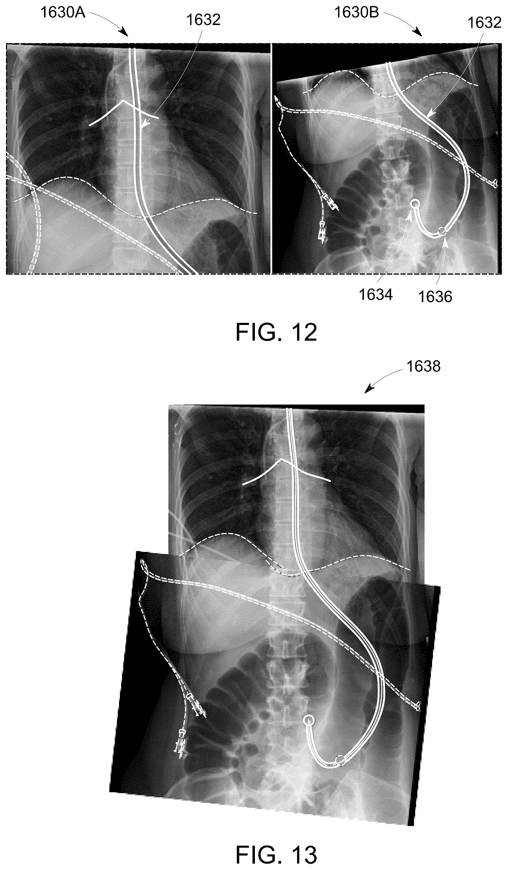 Patent US12315158 Figure 11 – System and method for visualizing placement of a medical tube or line