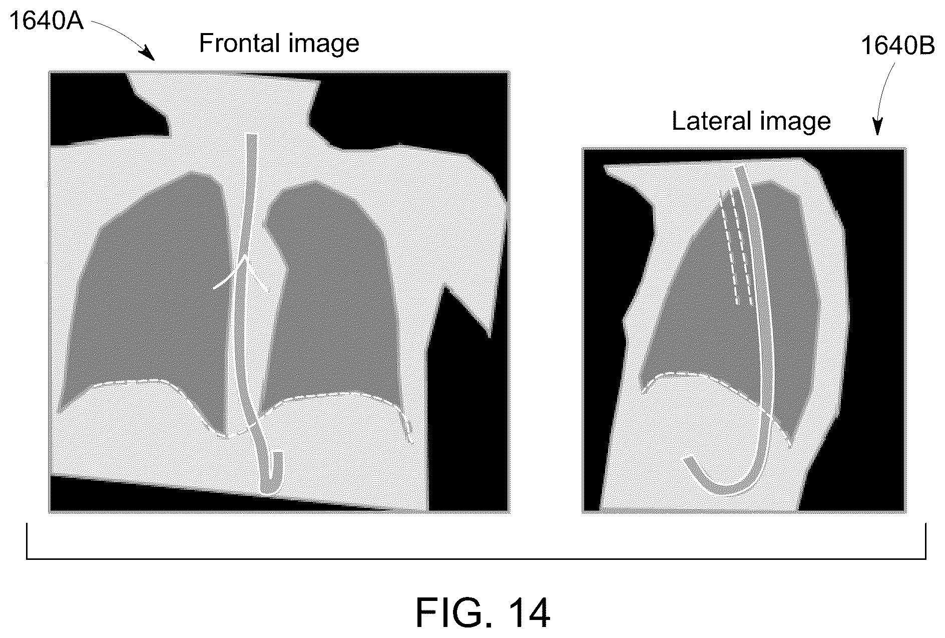 Patent US12315158 Figure 12 – System and method for visualizing placement of a medical tube or line