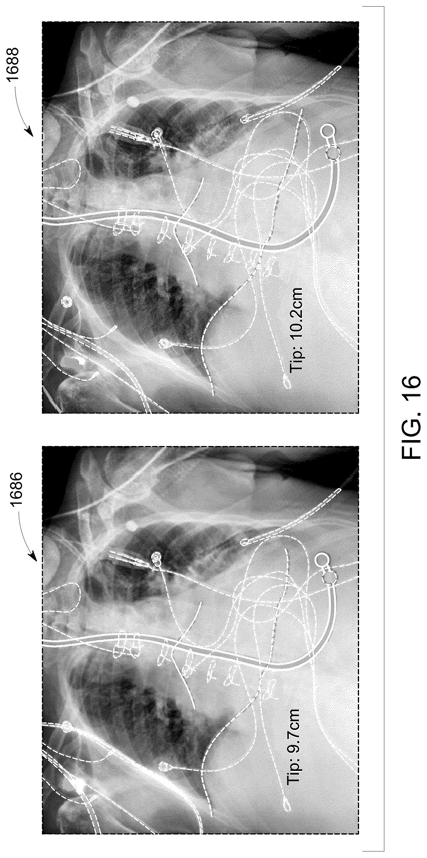 Patent US12315158 Figure 14 – System and method for visualizing placement of a medical tube or line