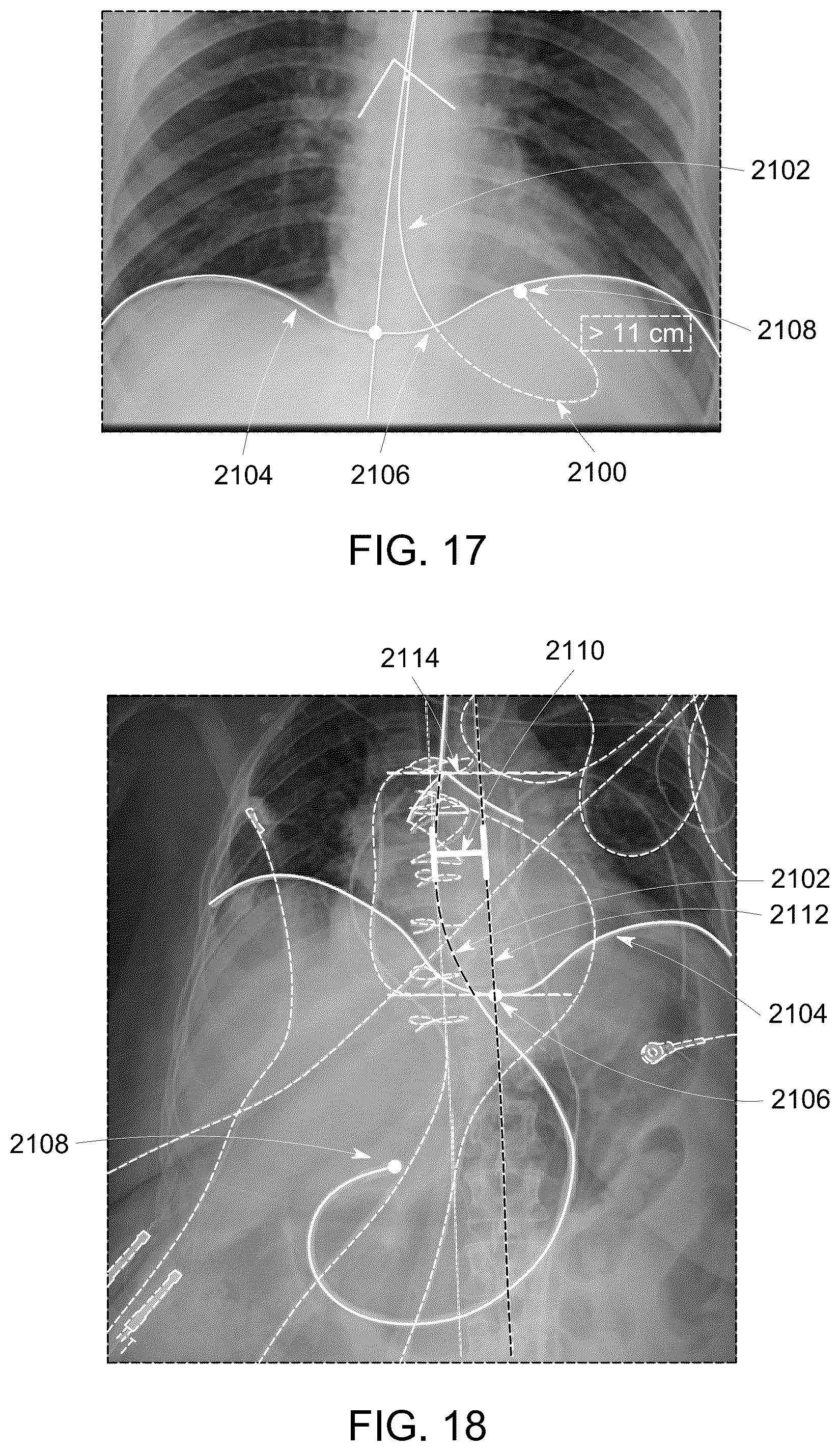 Patent US12315158 Figure 15 – System and method for visualizing placement of a medical tube or line