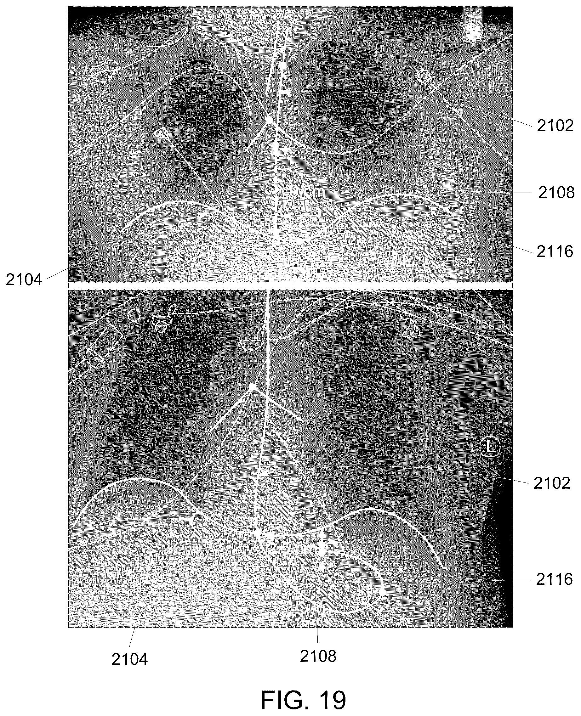 Patent US12315158 Figure 16 – System and method for visualizing placement of a medical tube or line