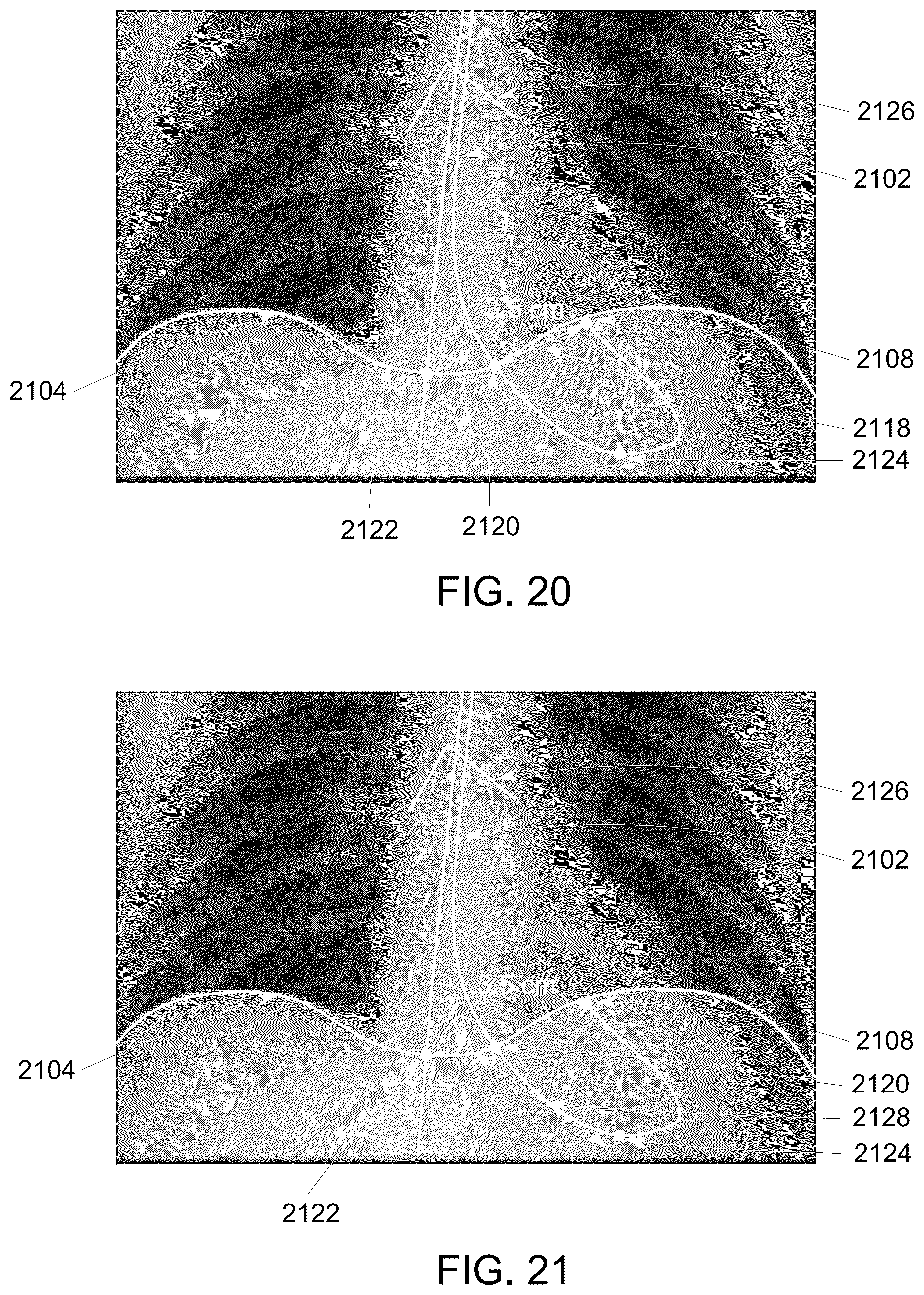 Patent US12315158 Figure 17 – System and method for visualizing placement of a medical tube or line