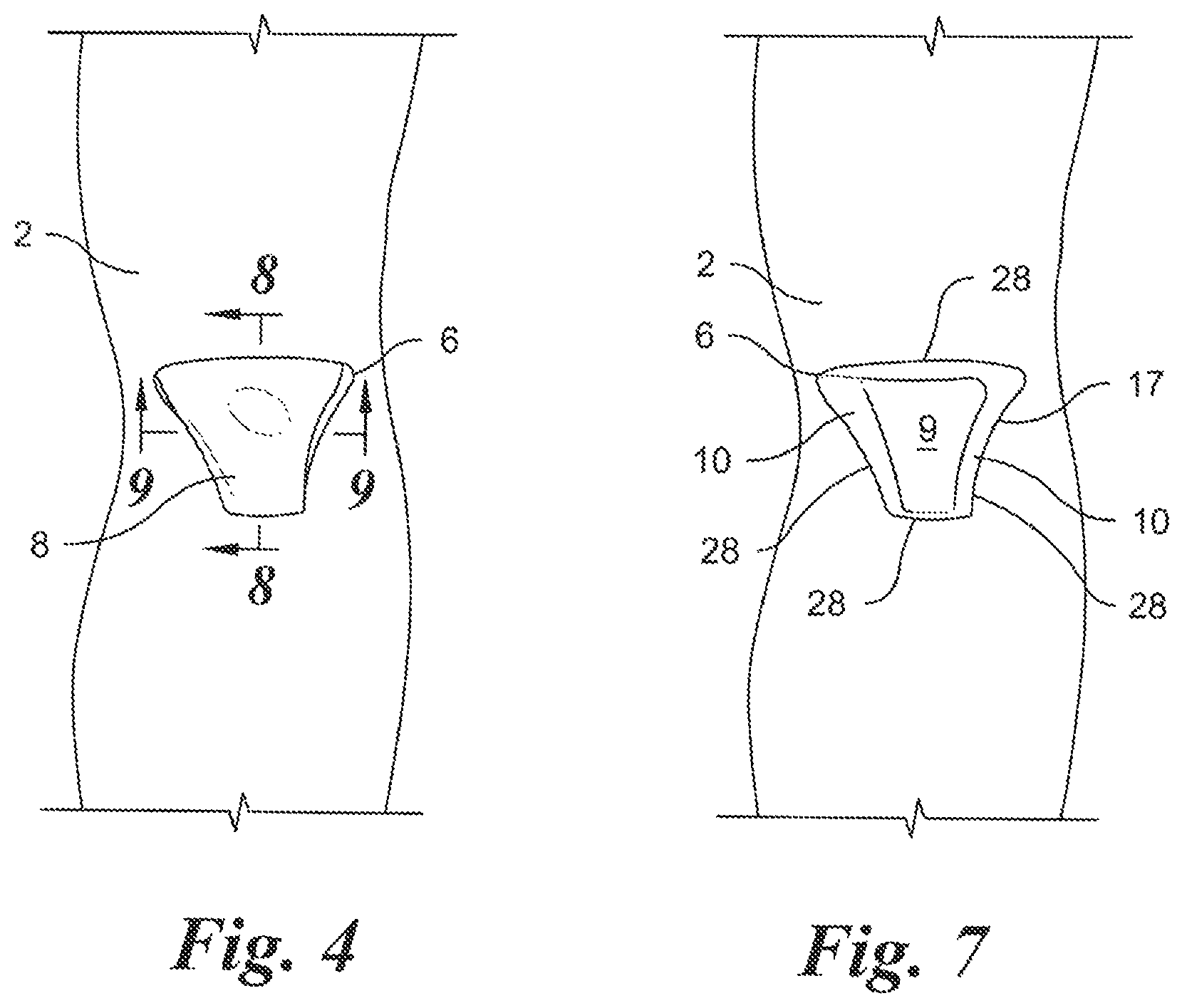 Patent US12315388 Figure 3 – Intraosseous infusion trainer