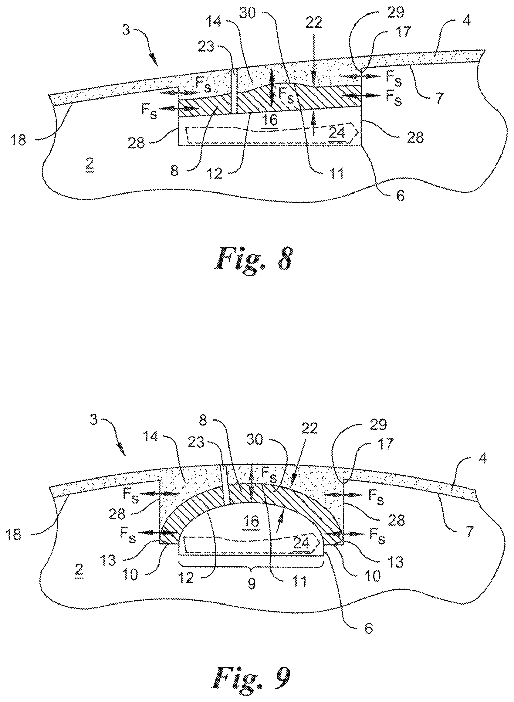 Patent US12315388 Figure 4 – Intraosseous infusion trainer
