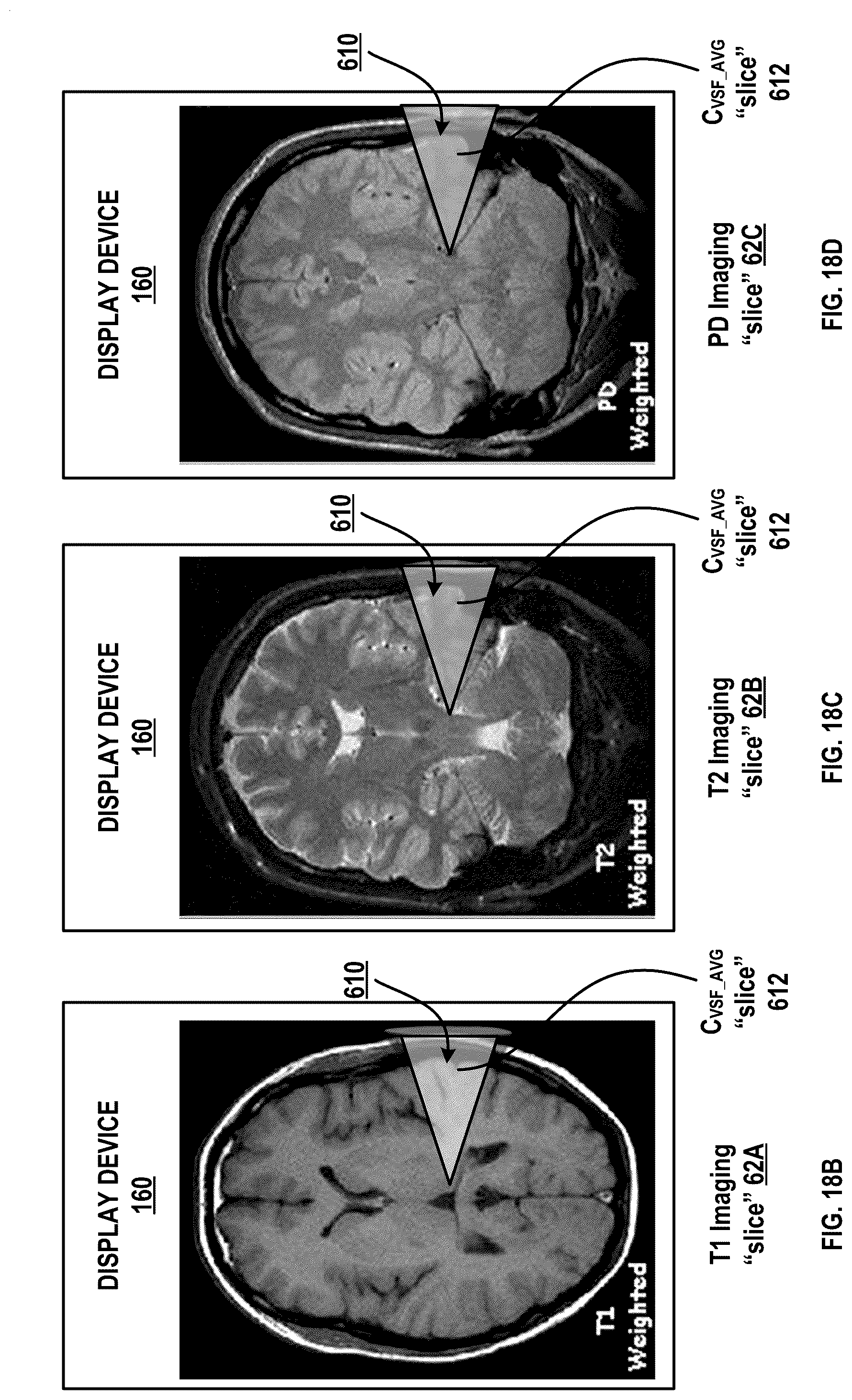 Patent US12315616 Figure 20 – Systems and methods for a spatial quantitative and anatomically accurate surgical corridor modeling platform