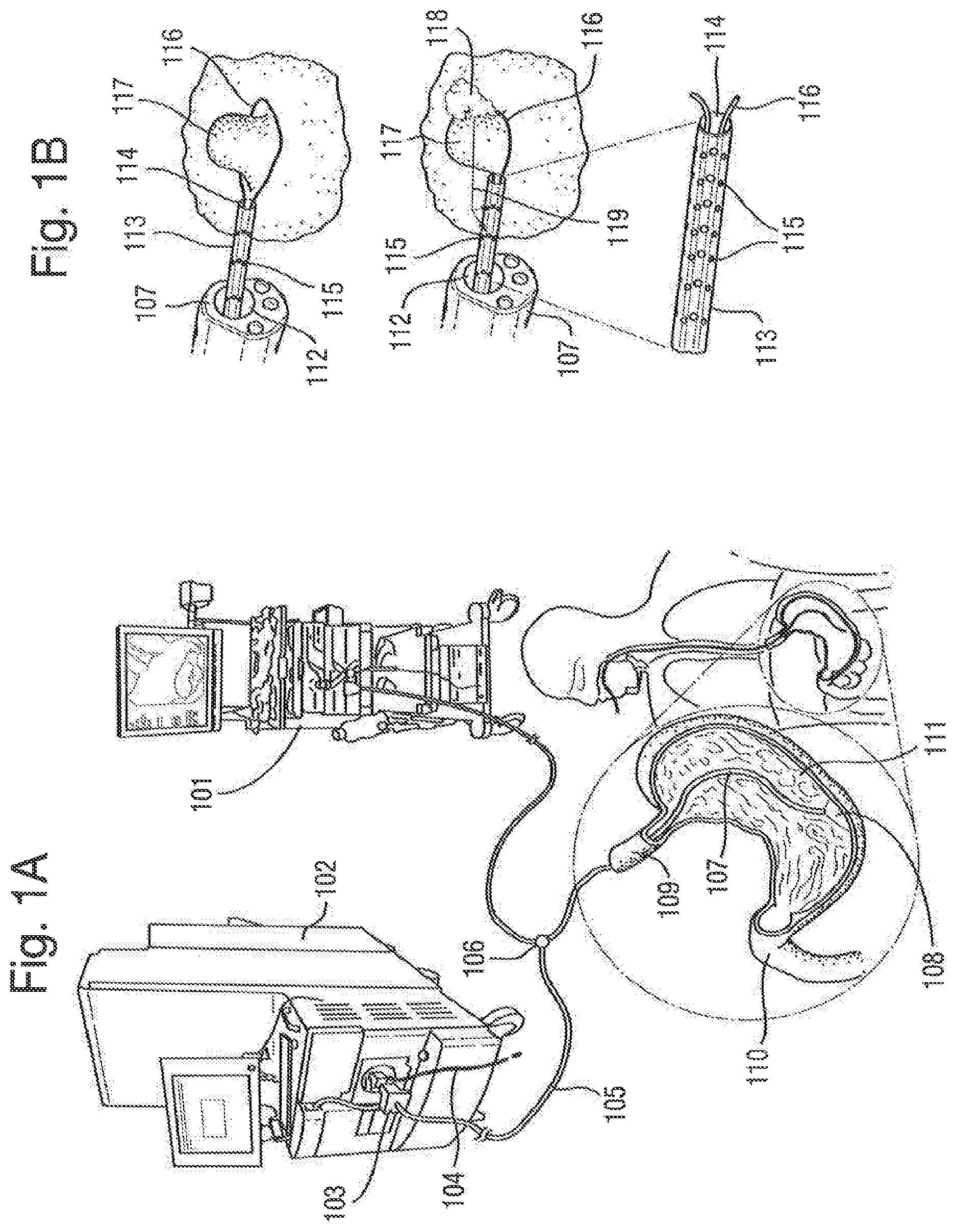 Patent US12315714 Figure 1 – Tissue analysis by mass spectrometry or ion mobility spectrometry