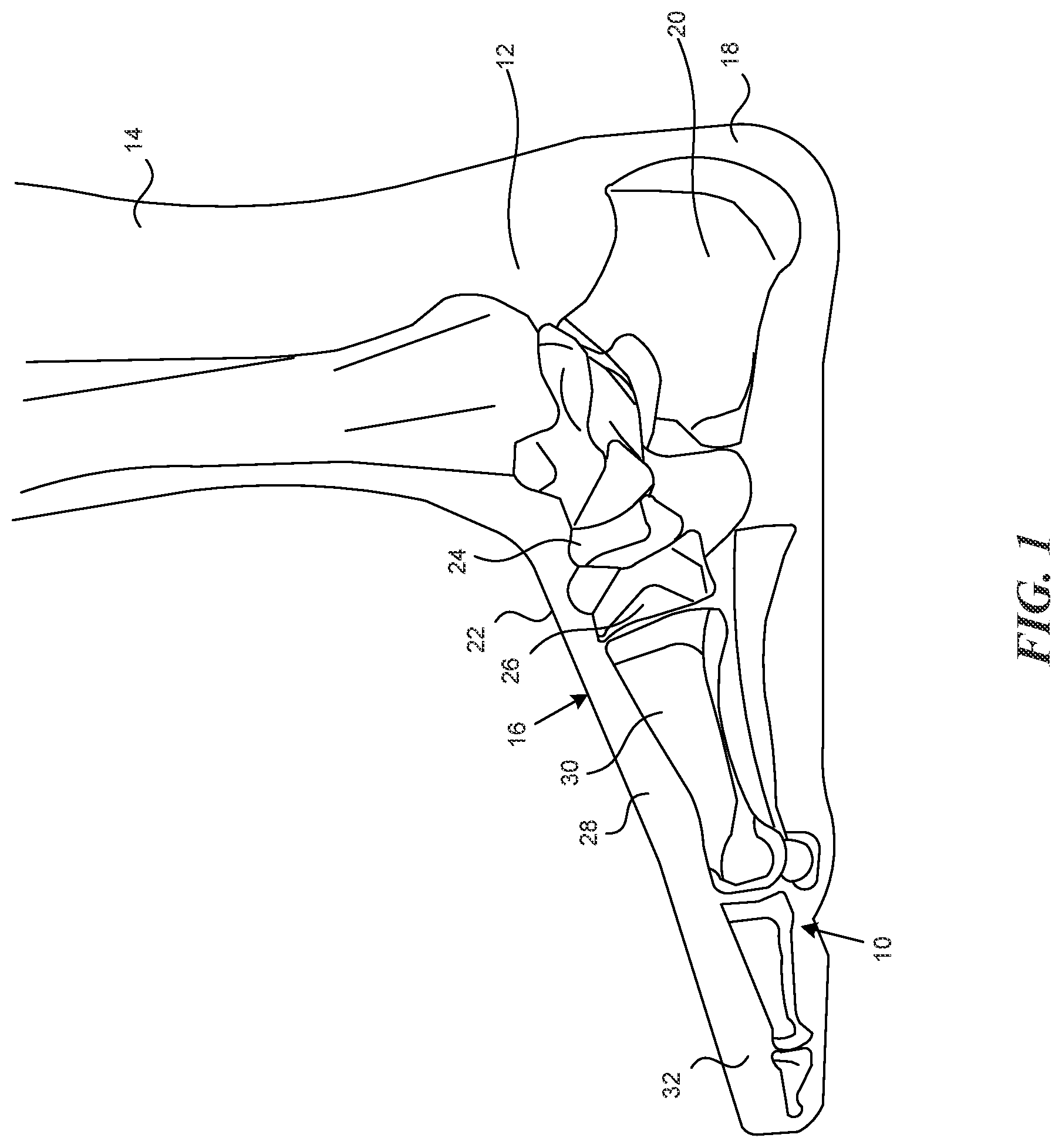 Patent US12317955 Figure 1 – Personalized footwear with integrated caging system