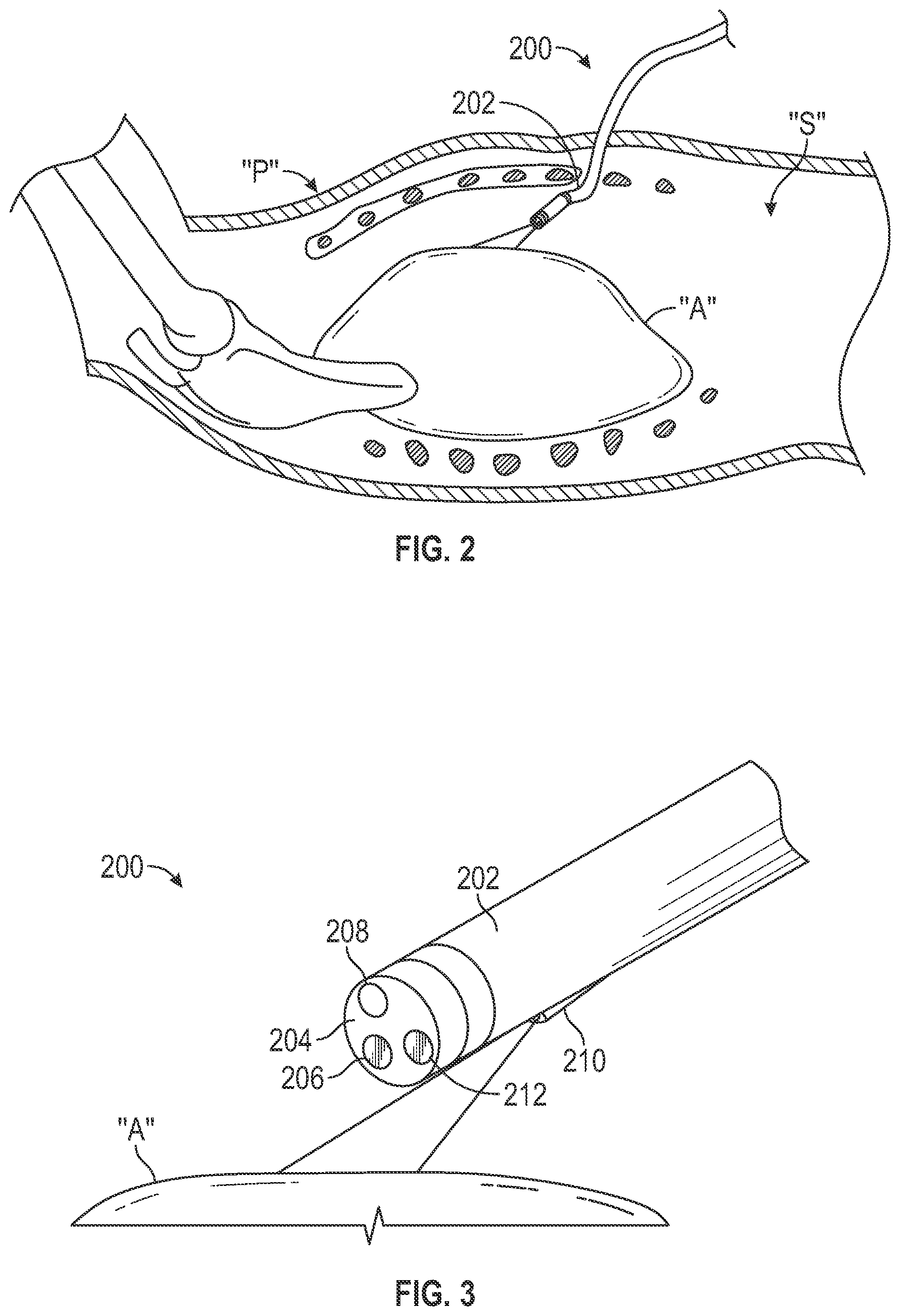 Patent US12318064 Figure 2 – Thoracic imaging, distance measuring, surgical awareness, and notification system and method