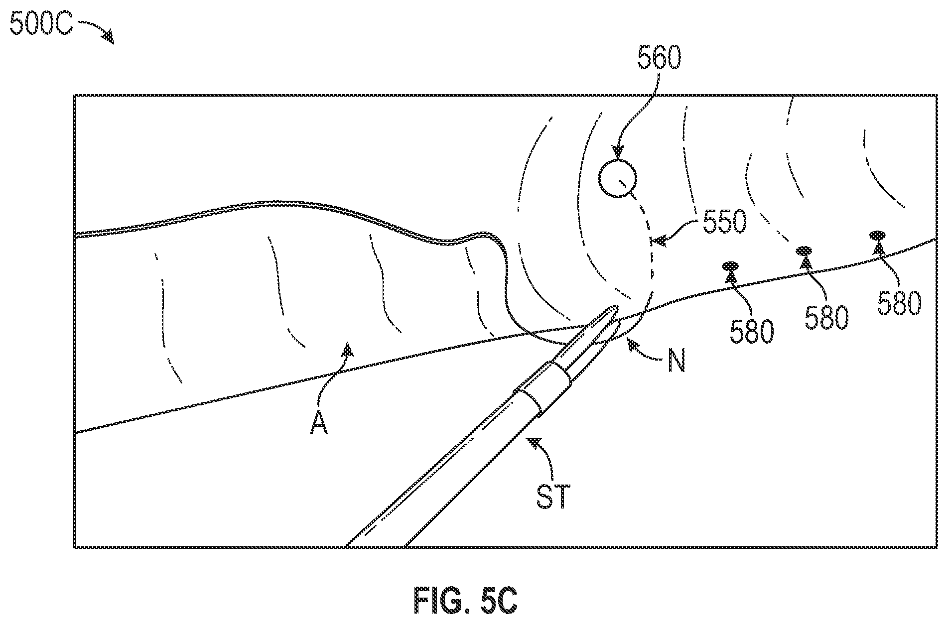 Patent US12318064 Figure 5 – Thoracic imaging, distance measuring, surgical awareness, and notification system and method