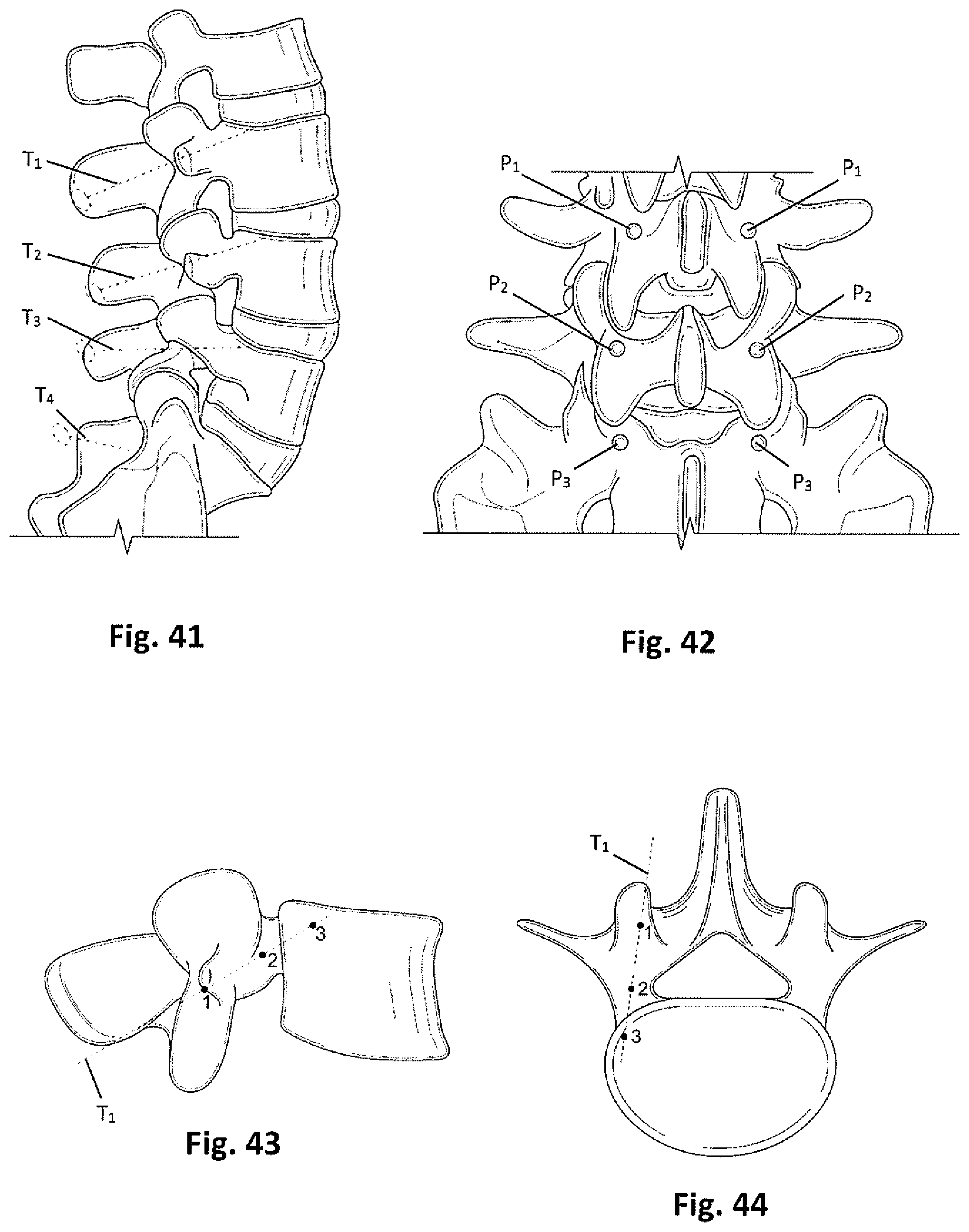 Patent US12318081 Figure 13 – Systems and methods for performing spine surgery