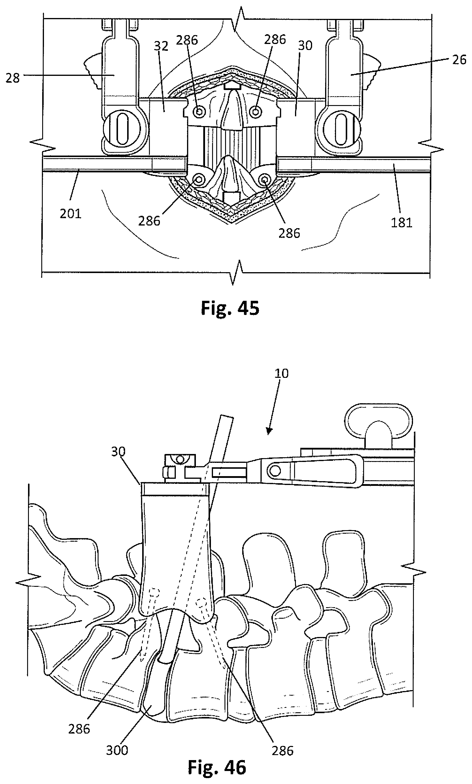 Patent US12318081 Figure 14 – Systems and methods for performing spine surgery