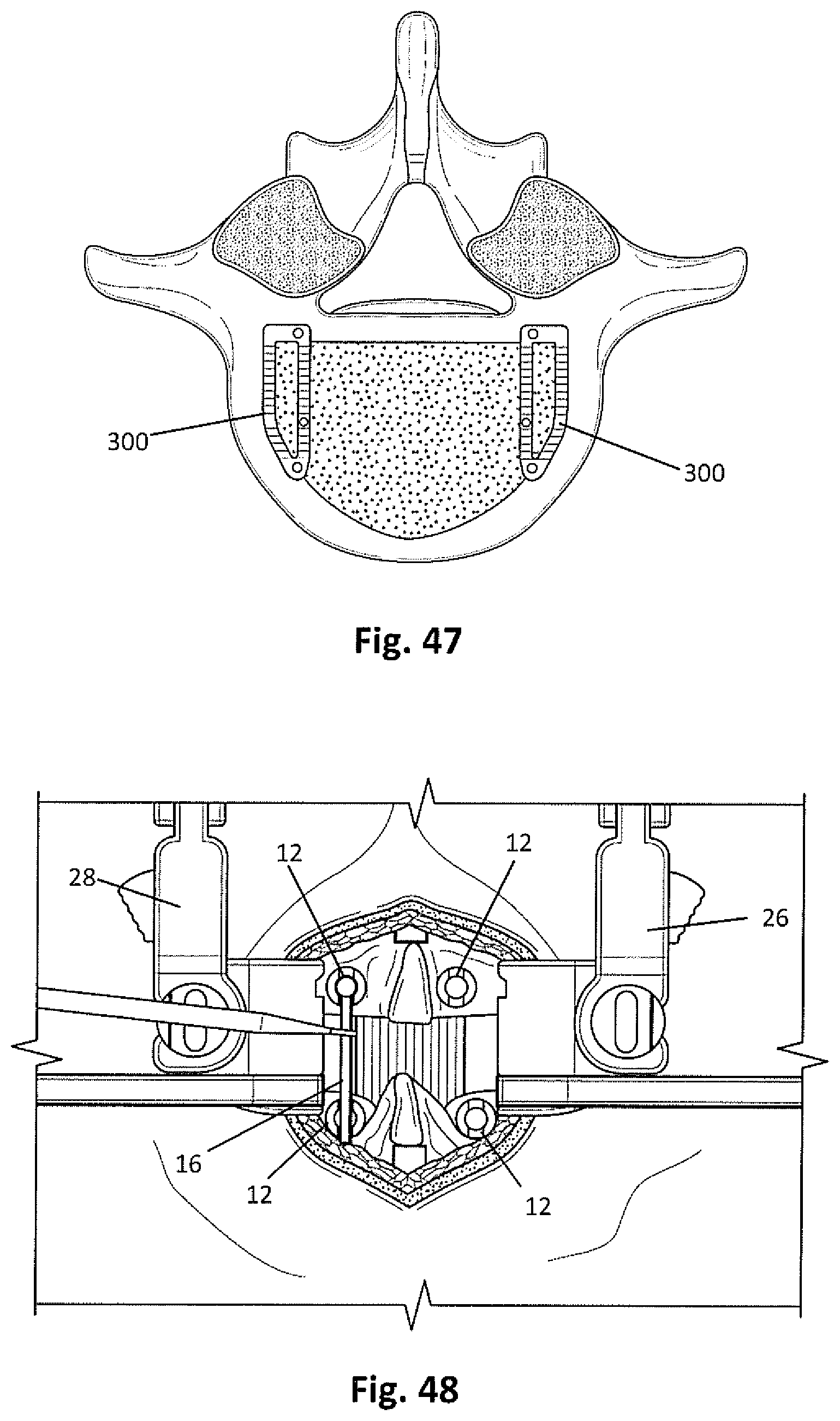 Patent US12318081 Figure 15 – Systems and methods for performing spine surgery