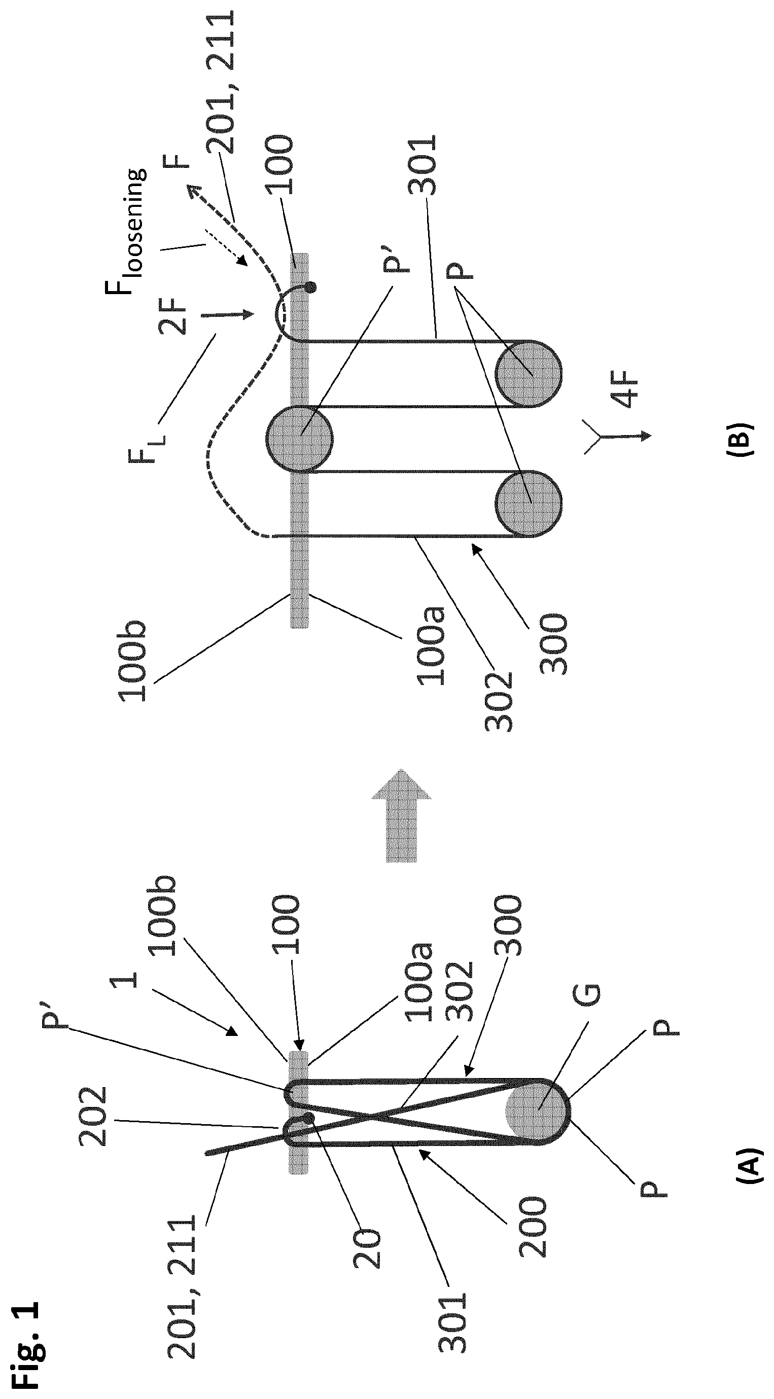 Patent US12318083 Figure 1 – Single strand self-locking suspension device for medical use