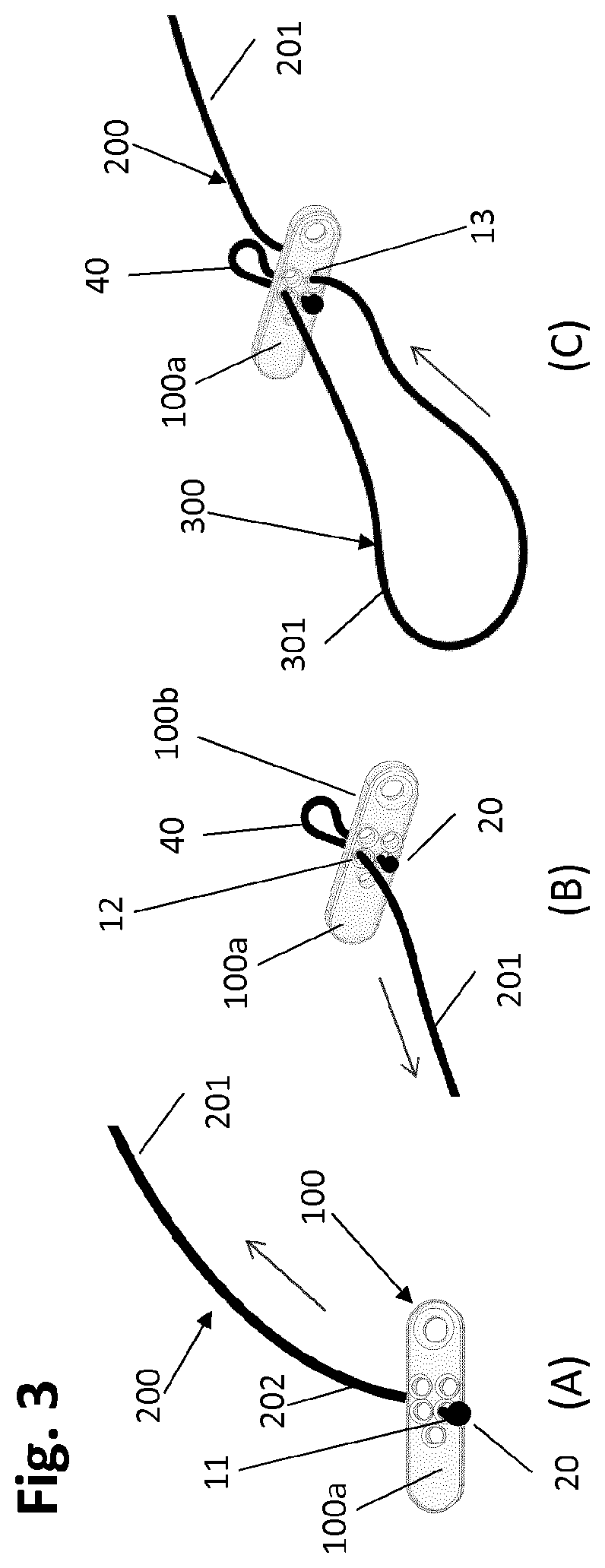 Patent US12318083 Figure 3 – Single strand self-locking suspension device for medical use