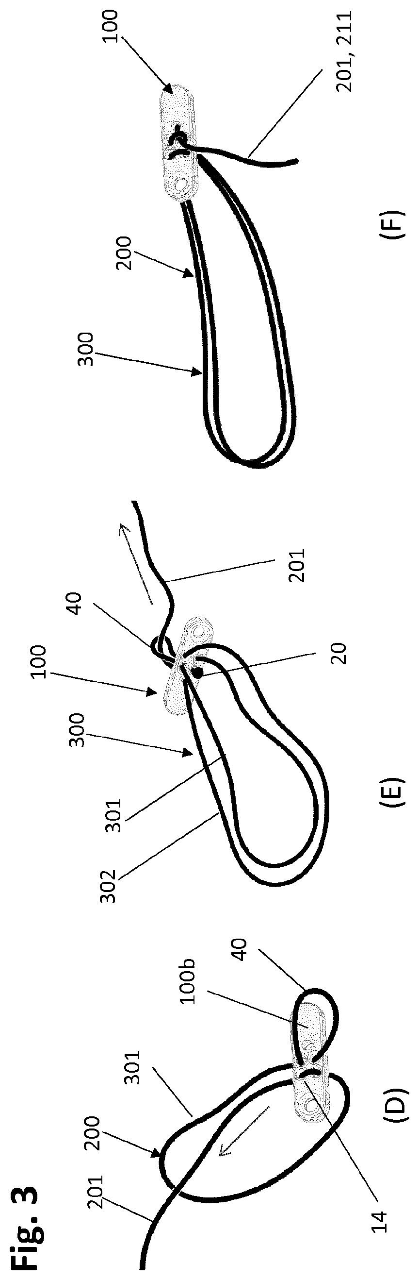 Patent US12318083 Figure 4 – Single strand self-locking suspension device for medical use