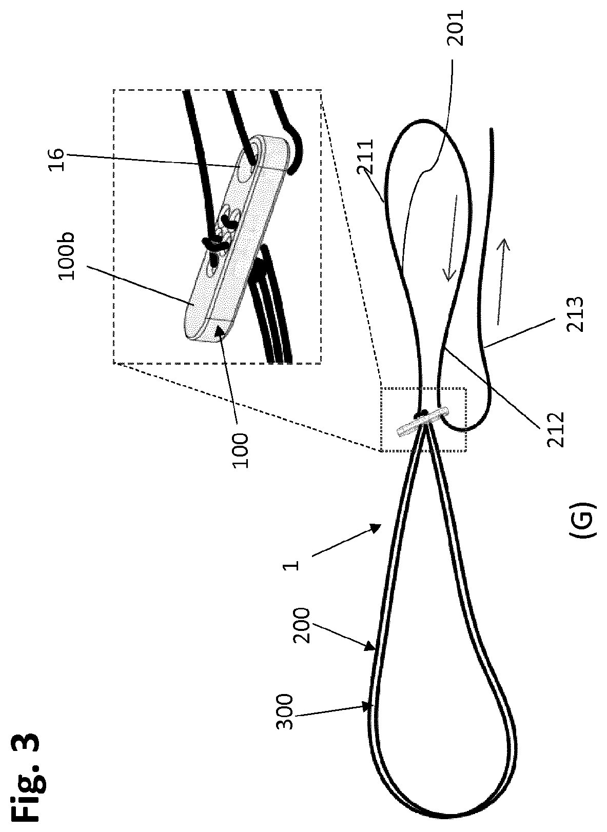 Patent US12318083 Figure 5 – Single strand self-locking suspension device for medical use