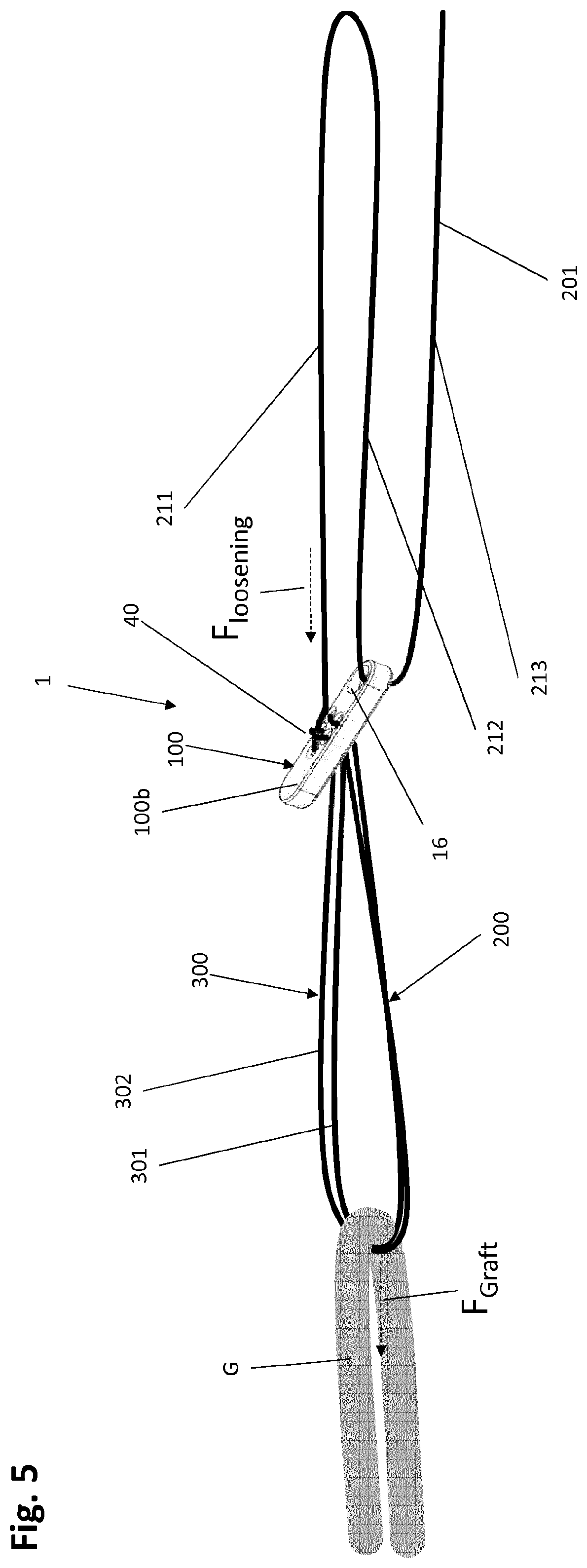Patent US12318083 Figure 7 – Single strand self-locking suspension device for medical use