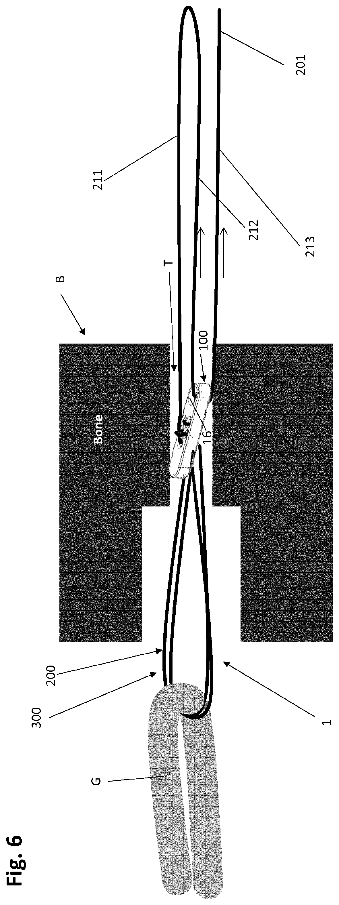 Patent US12318083 Figure 8 – Single strand self-locking suspension device for medical use