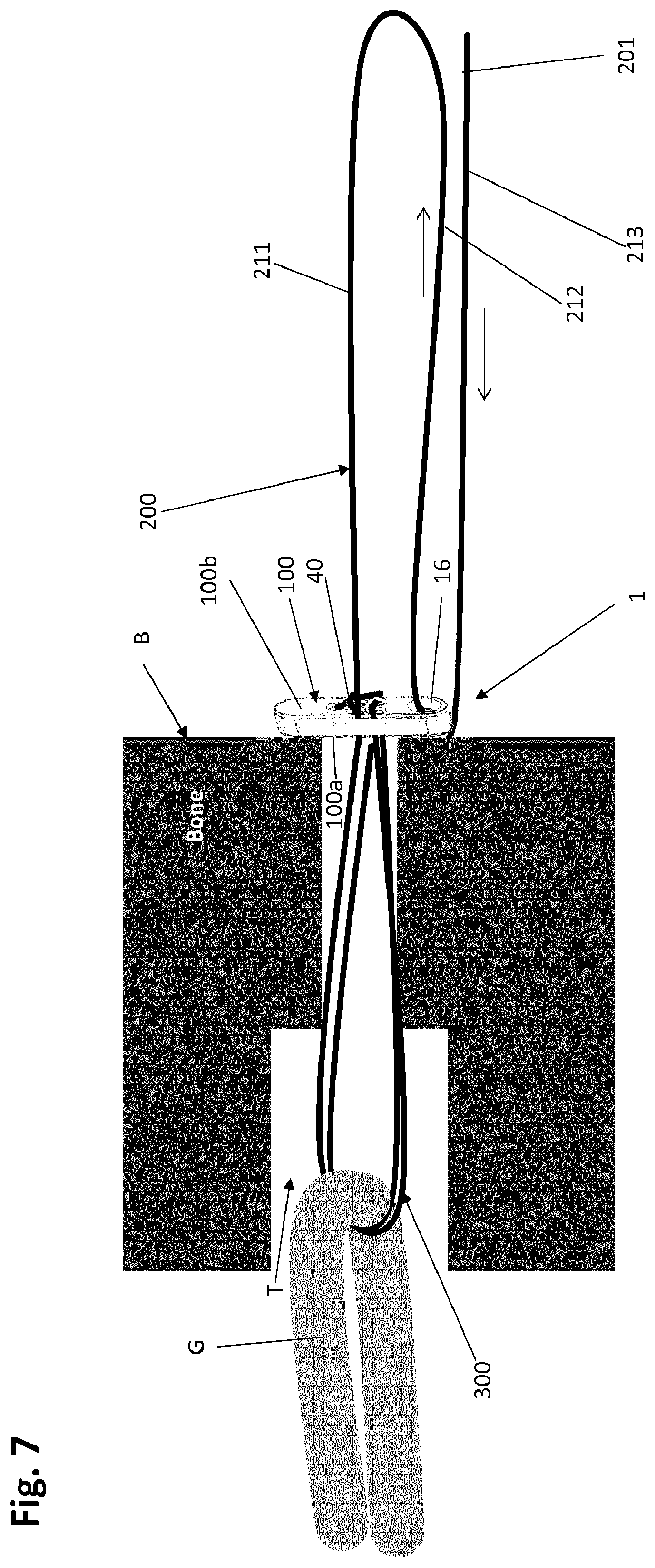 Patent US12318083 Figure 9 – Single strand self-locking suspension device for medical use