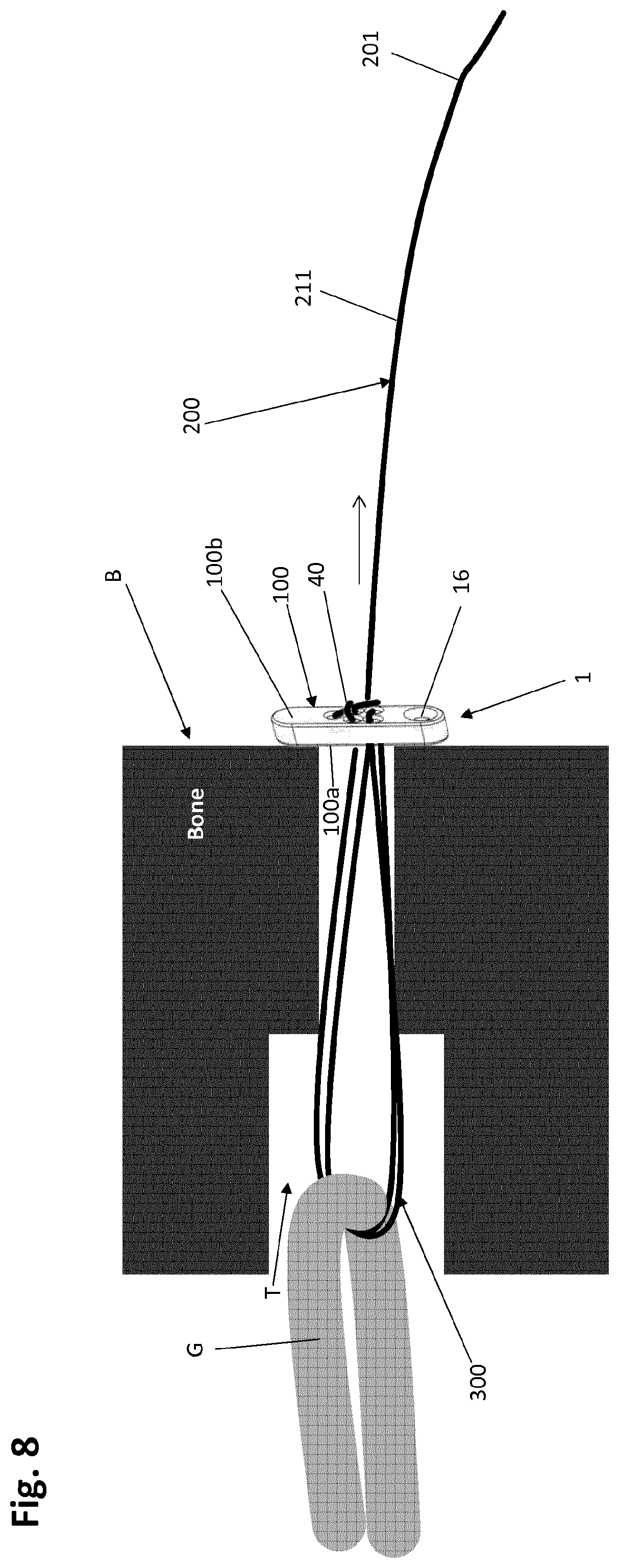 Patent US12318083 Figure 10 – Single strand self-locking suspension device for medical use