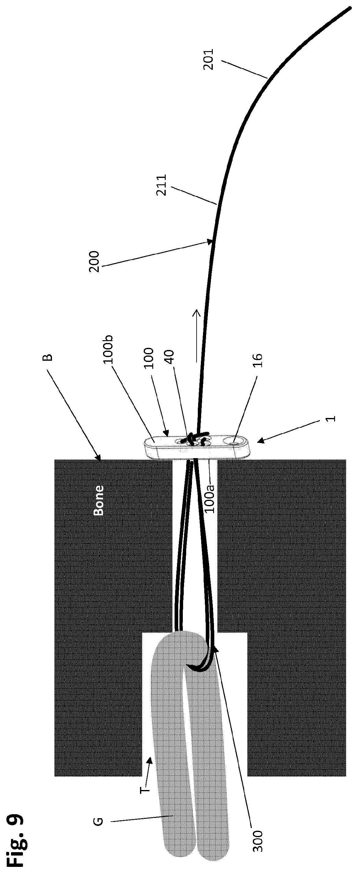 Patent US12318083 Figure 11 – Single strand self-locking suspension device for medical use