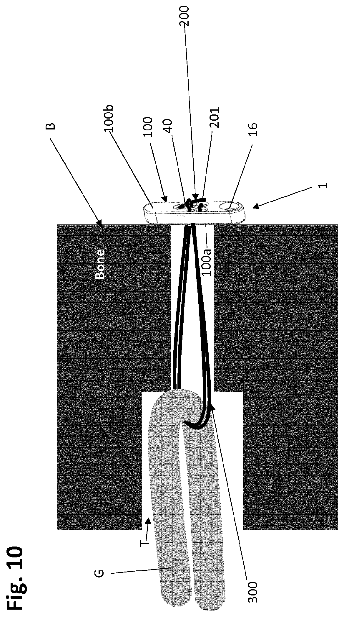 Patent US12318083 Figure 12 – Single strand self-locking suspension device for medical use